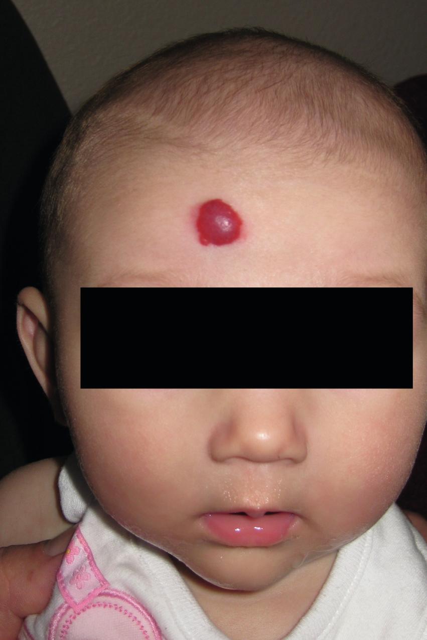 Fig. 41.1, Classic infantile hemangioma presenting of the central forehead. There is no evidence of ulceration or skin breakdown.