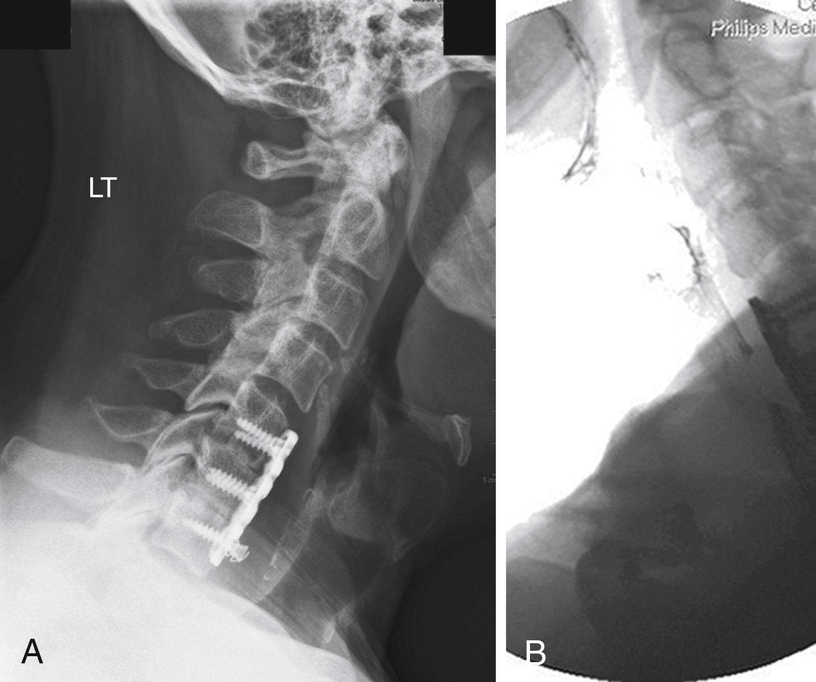 Fig. 96.1, A, Lateral radiograph of a patient who presented with dysphagia 2 years post anterior cervical discectomy and fusion showing backing out of an inferior screw in the setting of pseudarthrosis. B, Esophagram showing an intact esophagus without penetration of the screw into the esophagus. Note the close relationship of the plate to the esophagus.