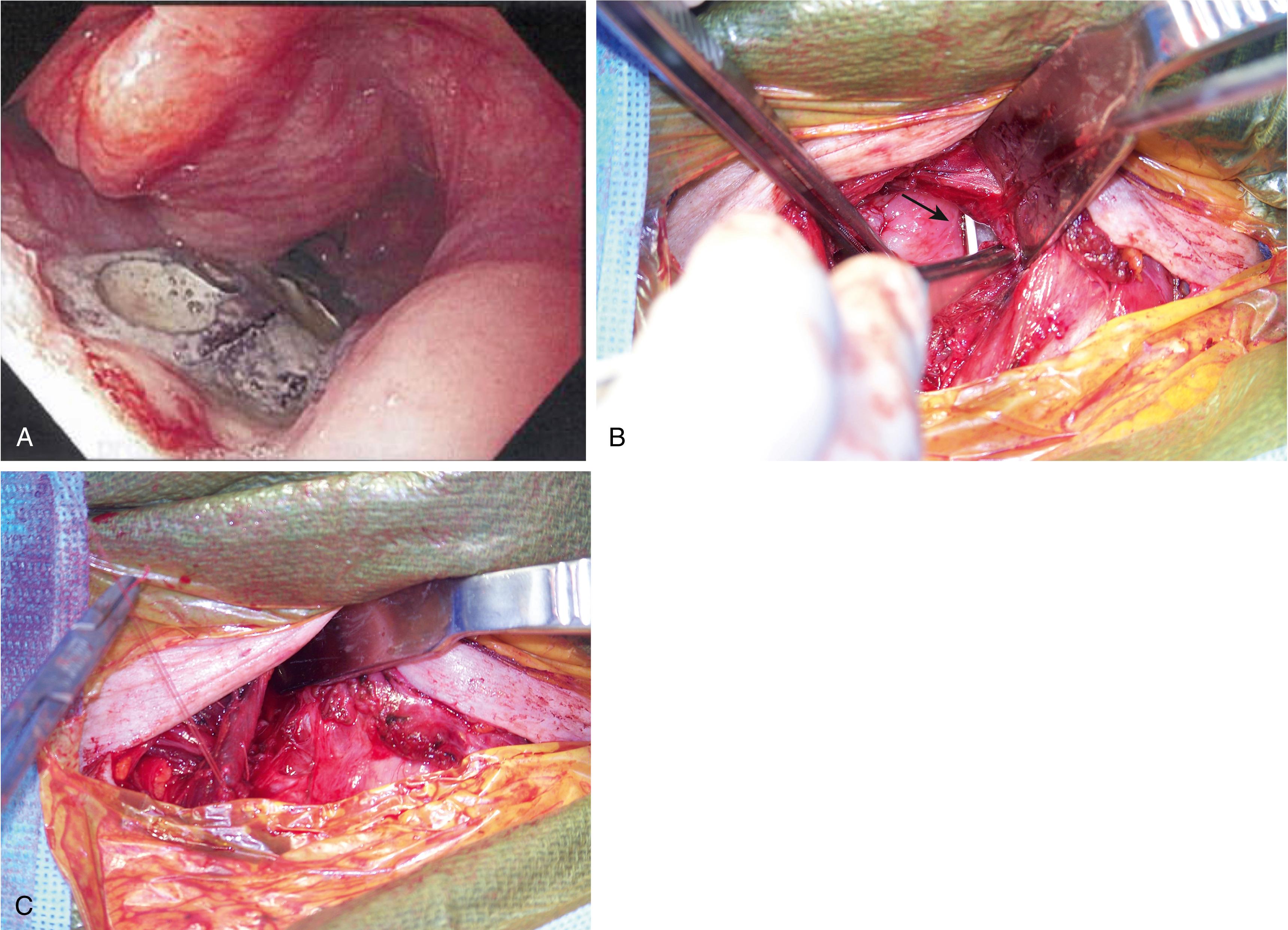 Fig. 96.2, A, Upper gastrointestinal endoscopy image of an anterior cervical plate that eroded through the esophagus 15 years after cervical surgery in the setting of rheumatoid arthritis and became impacted in the left arytenoid fossa. B, Intraoperative image confirming esophageal transmural injury (nasogastric tube shown by arrow). C, This was repaired with a sternocleidomastoid muscle flap.