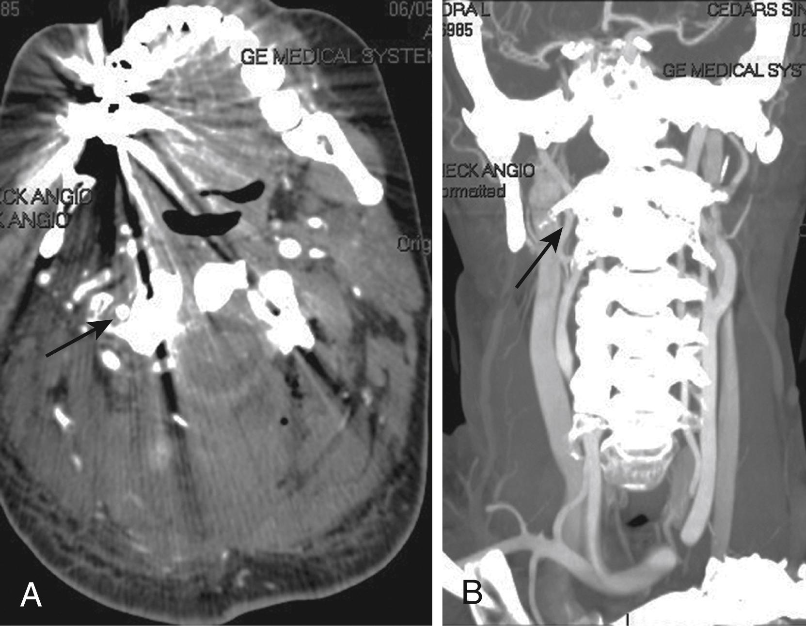 Fig. 96.3, A, Axial computed tomography angiogram image demonstrating a vertebral artery injury in a patient who underwent C1‒C2 arthrodesis. Note the patent vertebral artery at the level of C1 on the right ( arrow ) and its absence on the left. B, Coronal reconstruction in the same patient showing normal vertebral artery by C1 on the right ( arrow ) and its absence on the left.