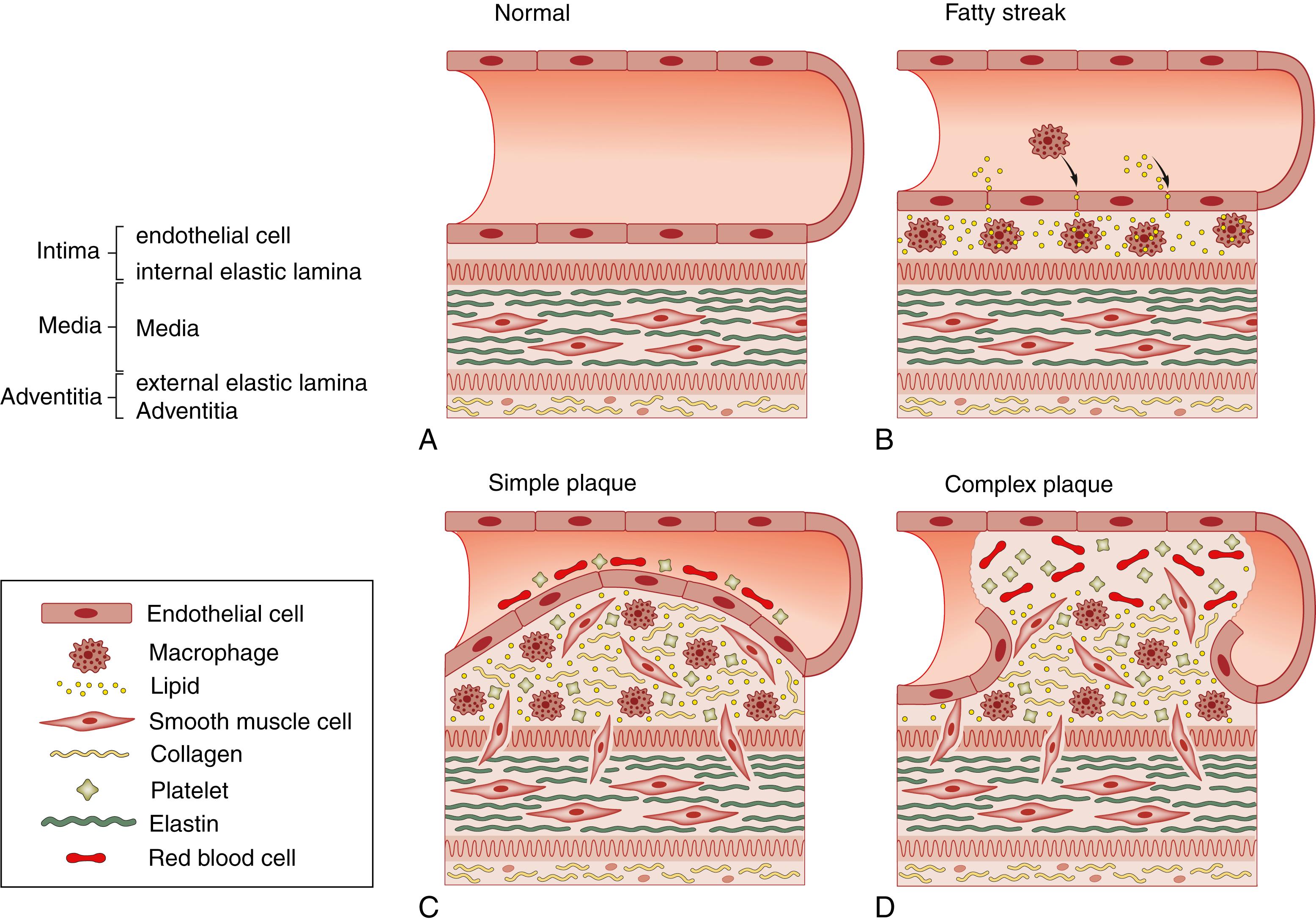 Fig. 22.1, Pathophysiology of atherosclerosis. (A) Normal arterial wall. The intima, comprising a single layer of endothelial cells, rests on a basement membrane and the internal elastic lamina. The media comprises smooth muscle cells and elastin, and the adventitia consists of collagenous tissue and vasa vasorum. (B) Fatty streak. Injured endothelial cells permit the sequestration of lipids and macrophages in the subendothelial space. (C) Simple plaque. Through the internal elastic lamina, smooth muscle cells enter the media, where they proliferate, take on the characteristics of fibroblasts and produce collagen. (D) Complex plaque. The endothelial cap has ruptured, leading to acute thrombosis and distal embolisation.