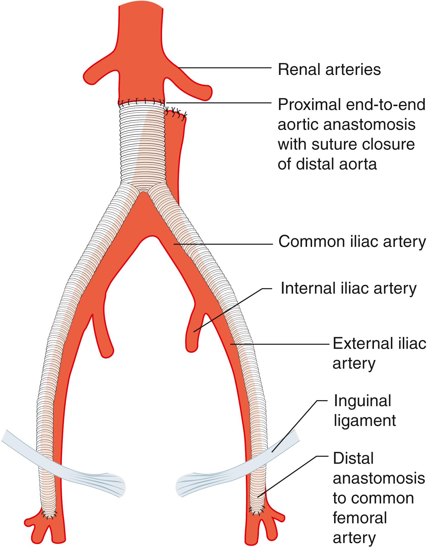 Fig. 22.11, Anatomic aortic bypass. Reconstruction of an occluded aorto-iliac segment using an aorto-bifemoral bypass graft.