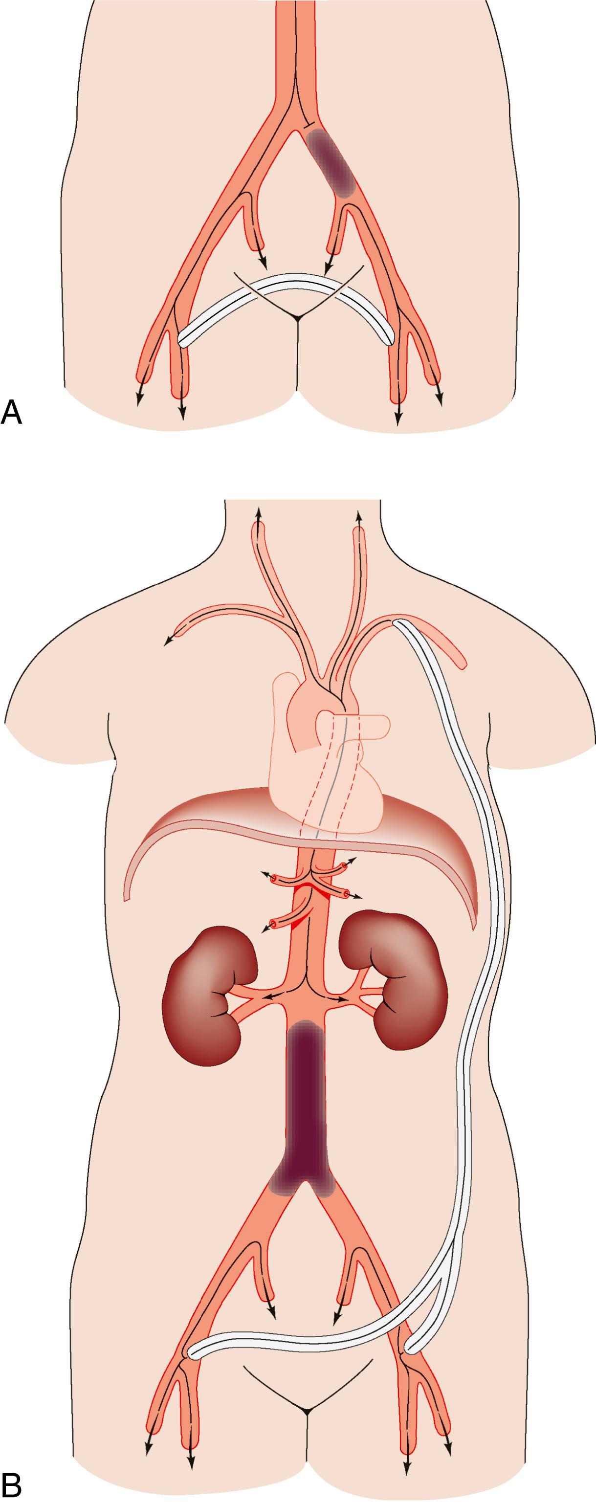 Fig. 22.12, Extraanatomic bypass. (A) Unilateral iliac disease may be treated by femoro-femoral crossover graft. (B) Bilateral aorto-iliac disease may be treated with axillo-bifemoral bypass graft.