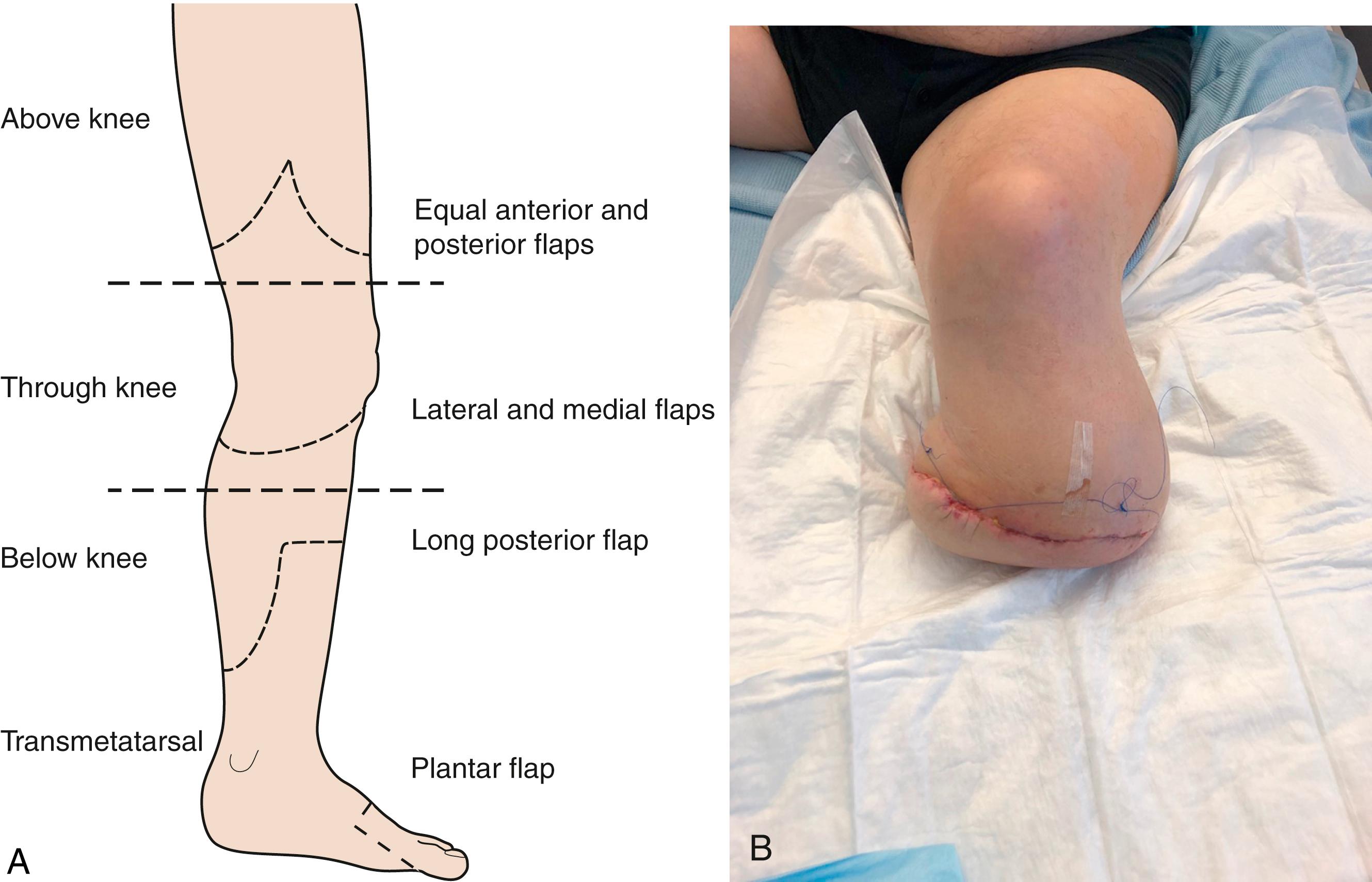 Fig. 22.13, Amputation. (A) Levels of amputation and types of flaps used to close the residual defect. (B) Below-knee amputation.