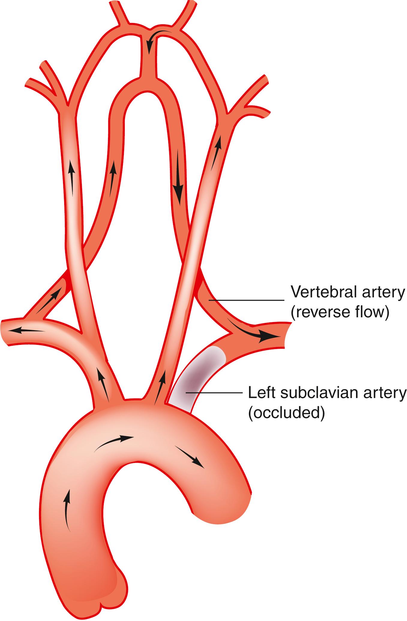 Fig. 22.14, Occlusion of the left subclavian artery, causing ‘subclavian steal’.