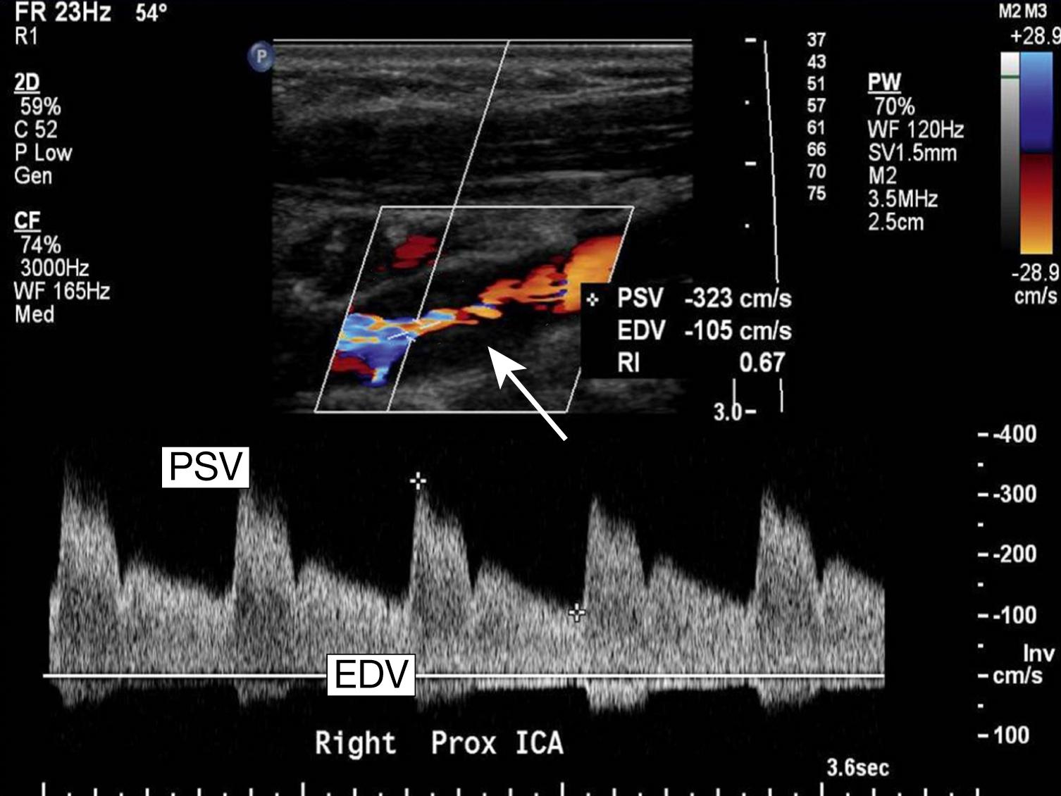 Fig. 22.15, Carotid ultrasound scan. The upper image shows the narrowing ( arrow ). By using Doppler ultrasound to measure the peak systolic velocity (PSV; about 300 cm/s in this case) and end-diastolic velocity (EDV; about 120 cm/s in this case) of the blood travelling through the stenosis, it is possible to quantify the degree of narrowing. In this case the stenosis is estimated at greater than 70%, so further investigation with a view to surgery is warranted.