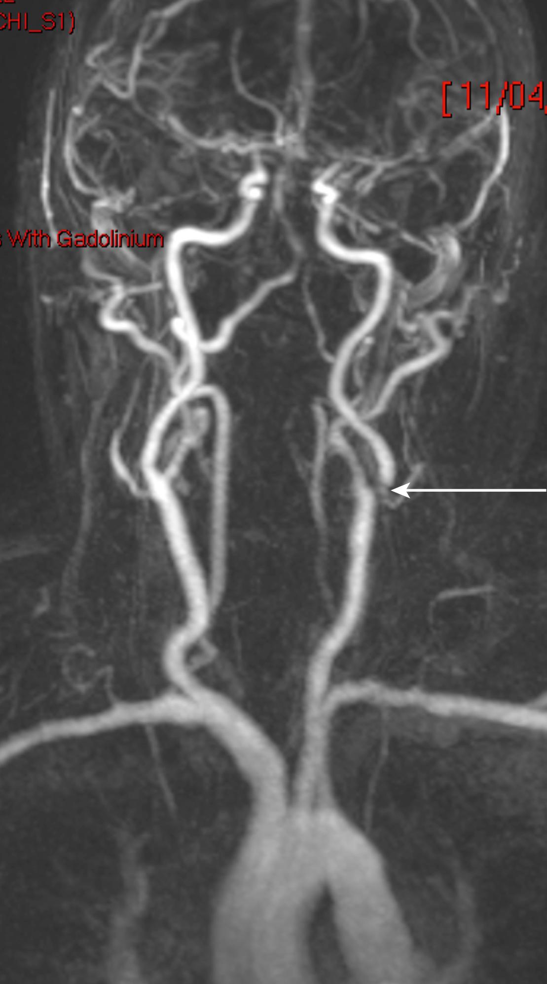 Fig. 22.16, Carotid magnetic resonance angiogram (MRA). The arterial blood to the brain from the origins of the great vessels from the aortic arch to the circle of Willis and cerebral arteries within the skull. The image confirms that there is a tight stenosis at the origin of the left internal carotid artery ( arrow ).