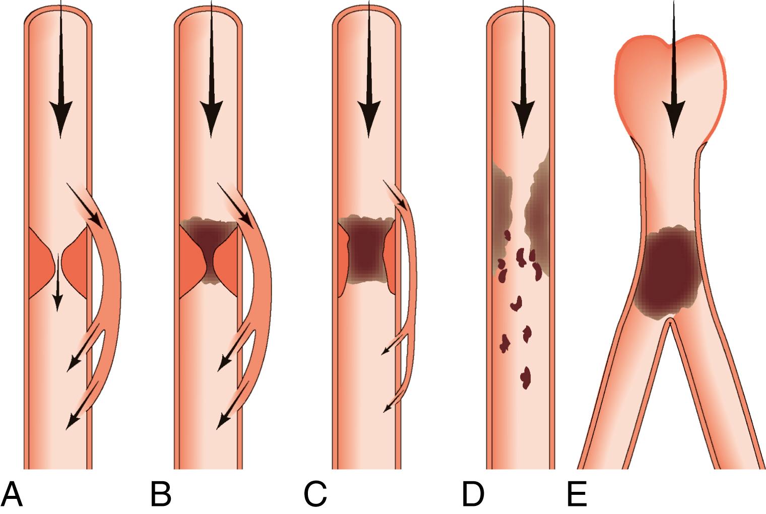 Fig. 22.2, Mechanisms of injury in atherosclerotic disease. (A) Critical stenosis of main artery compensated for by collateral vessels only symptomatic on exercise. (B) Acute thrombosis of a critical stenosis; little change in clinical status because of well-developed collaterals. (C) Acute thrombosis of a noncritical stenosis; severe symptoms because collateral supply is poorly developed. (D) Atheroembolism from ruptured, ulcerated plaque. (E) Thromboembolism from the heart; severe ischaemia because of lack of collateral supply.