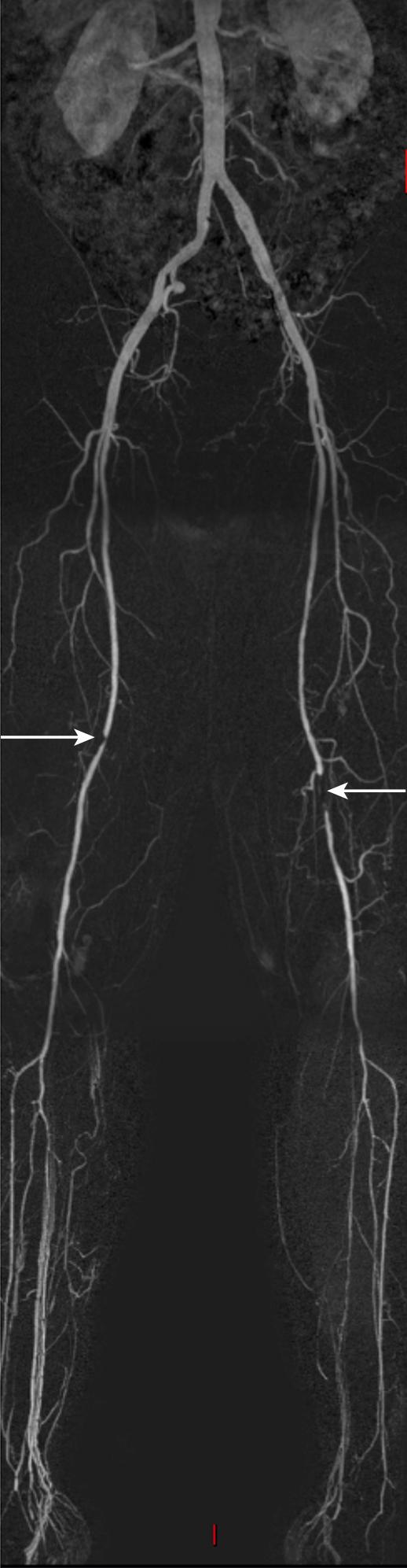 Fig. 22.5, Magnetic resonance angiogram showing diffuse disease in both right and left superficial femoral arteries ( arrows ).