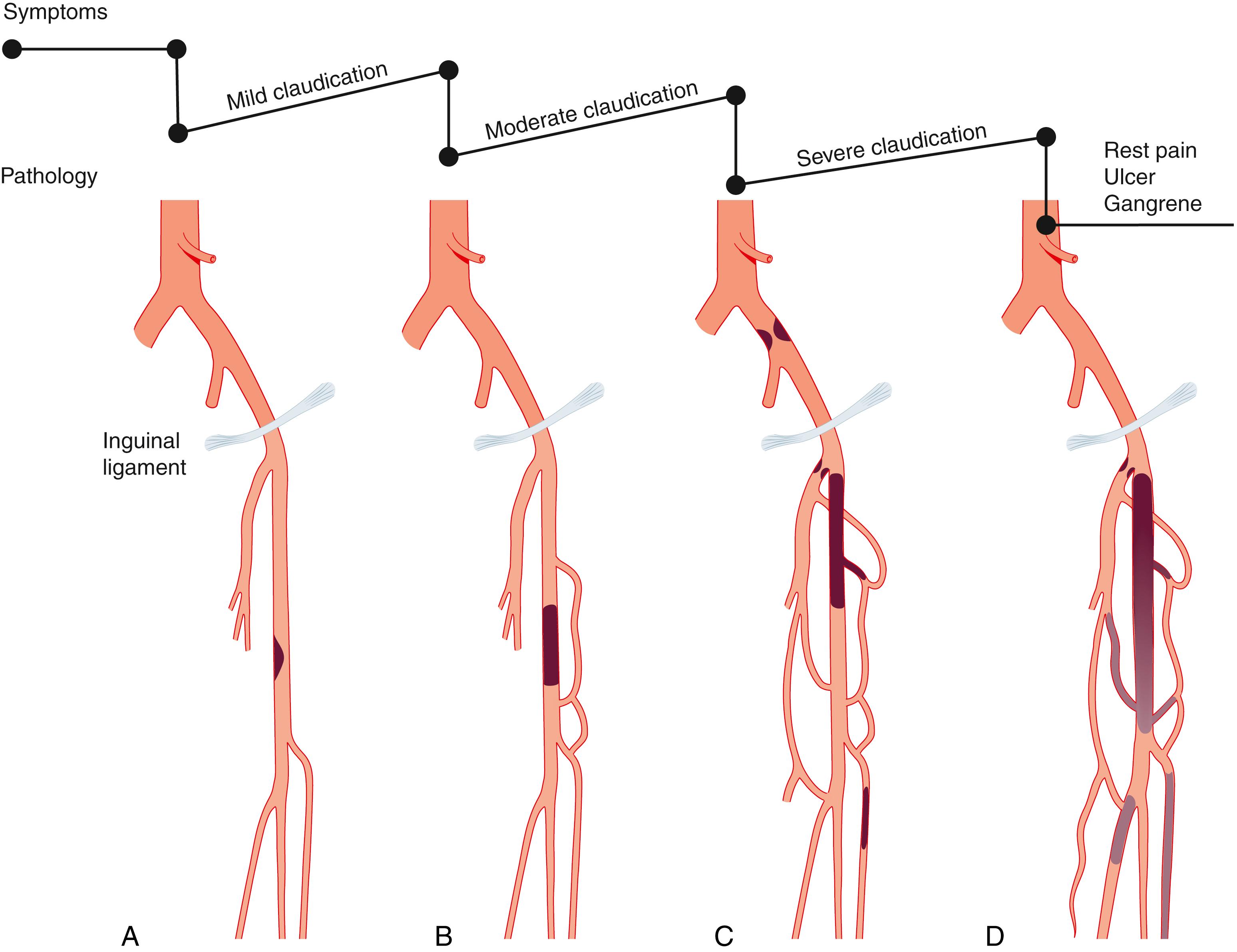 Fig. 22.6, Symptoms and pathology in intermittent claudication. (A) Superficial femoral artery (SFA) stenosis at adductor canal. (B) Occlusion of the SFA and development of a collateral circulation between the deep femoral (profunda femoris) artery (PFA) and the popliteal artery. (C) Iliac artery and PFA stenosis leading to worsening symptoms of intermittent claudication and further collateralisation. (D) Eventually, chronic limb threatening limb ischaemia, characterised by ischaemic rest pain and tissue loss, develops as a result of multilevel disease affecting the tibial arteries and collateral supply.