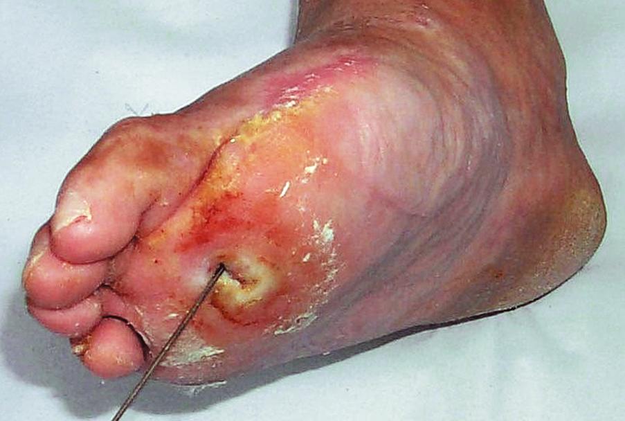 Fig. 22.7, Neuropathic ulceration of the first metatarsal head with sinus entering joint space.