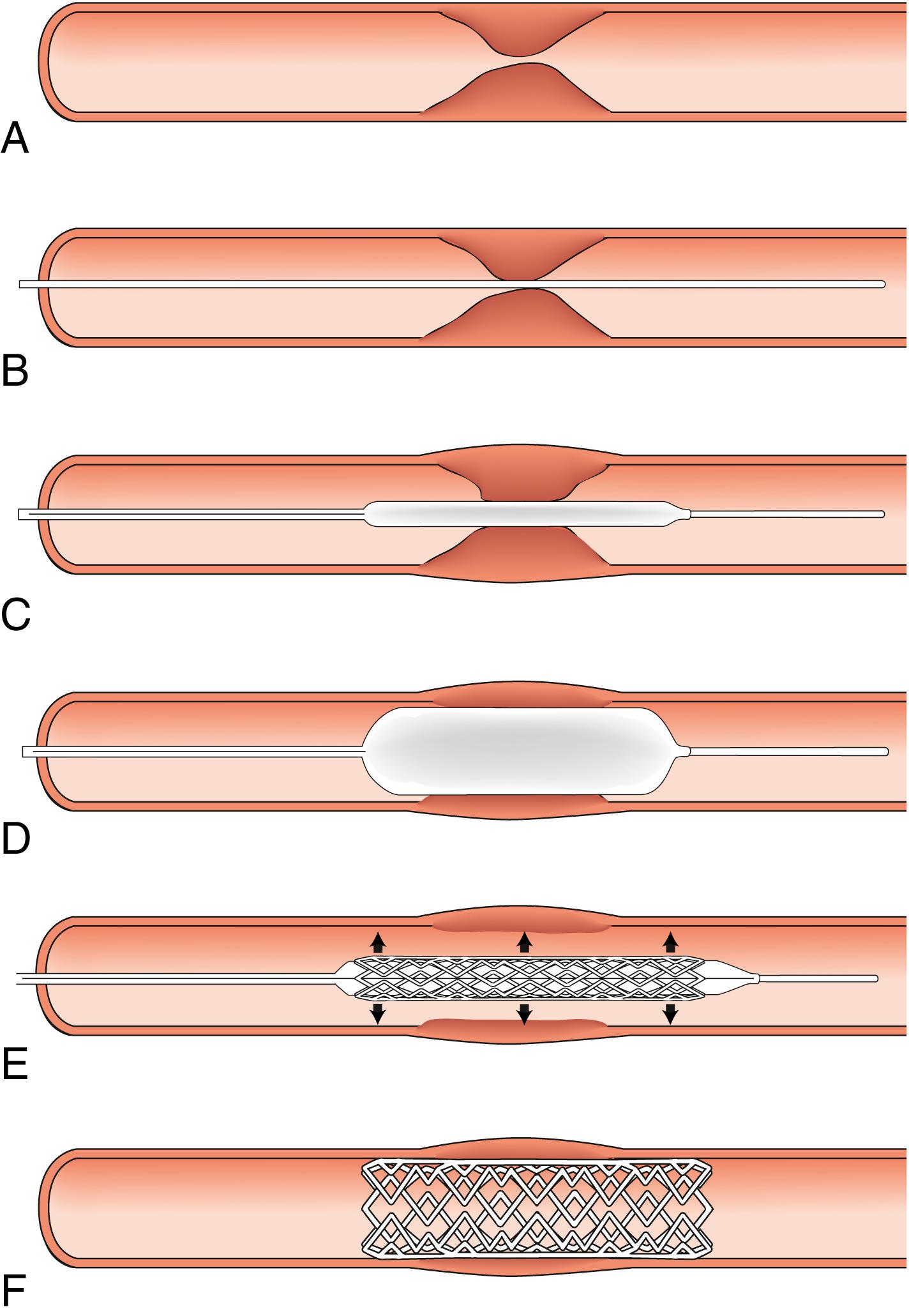 Fig. 22.8, Balloon angioplasty and stenting. (A) Critical arterial stenosis. (B) A guidewire is used to cross the lesion. (C) The guidewire is used to direct a balloon angioplasty catheter across the lesion. (D) The balloon is inflated. (E) A metal stent may be mounted on a catheter. The stent may be self-expanding or require expansion with a balloon. In many cases, the first manoeuvre is to cross the lesion with a stent, and in this circumstance, steps C and D may be omitted. (F) Metal stent holding open the stenosis.