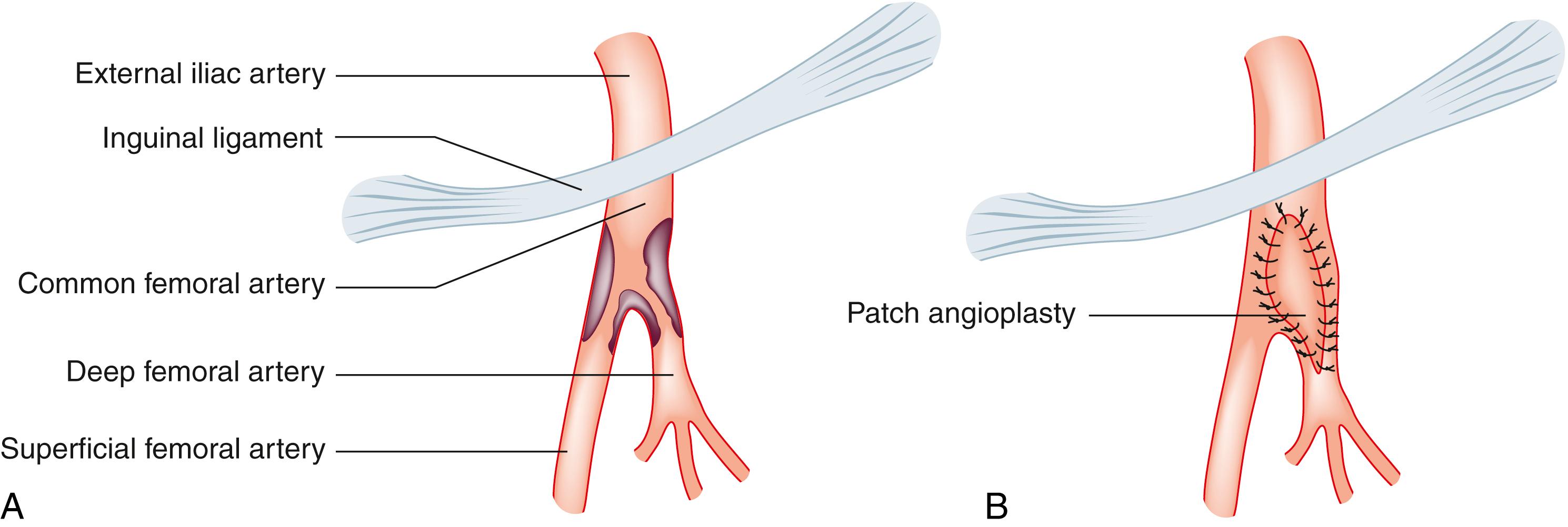 Fig. 22.9, Profundaplasty. (A) Focal atherosclerotic disease of the left common femoral artery is causing severe ischaemia because it is obstructing flow down the superficial and deep femoral (profunda femoris) arteries. (B) Local endarterectomy and closure of the profunda femoris using a vein or prosthetic patch (profundaplasty) restores normal flow to both vessels.