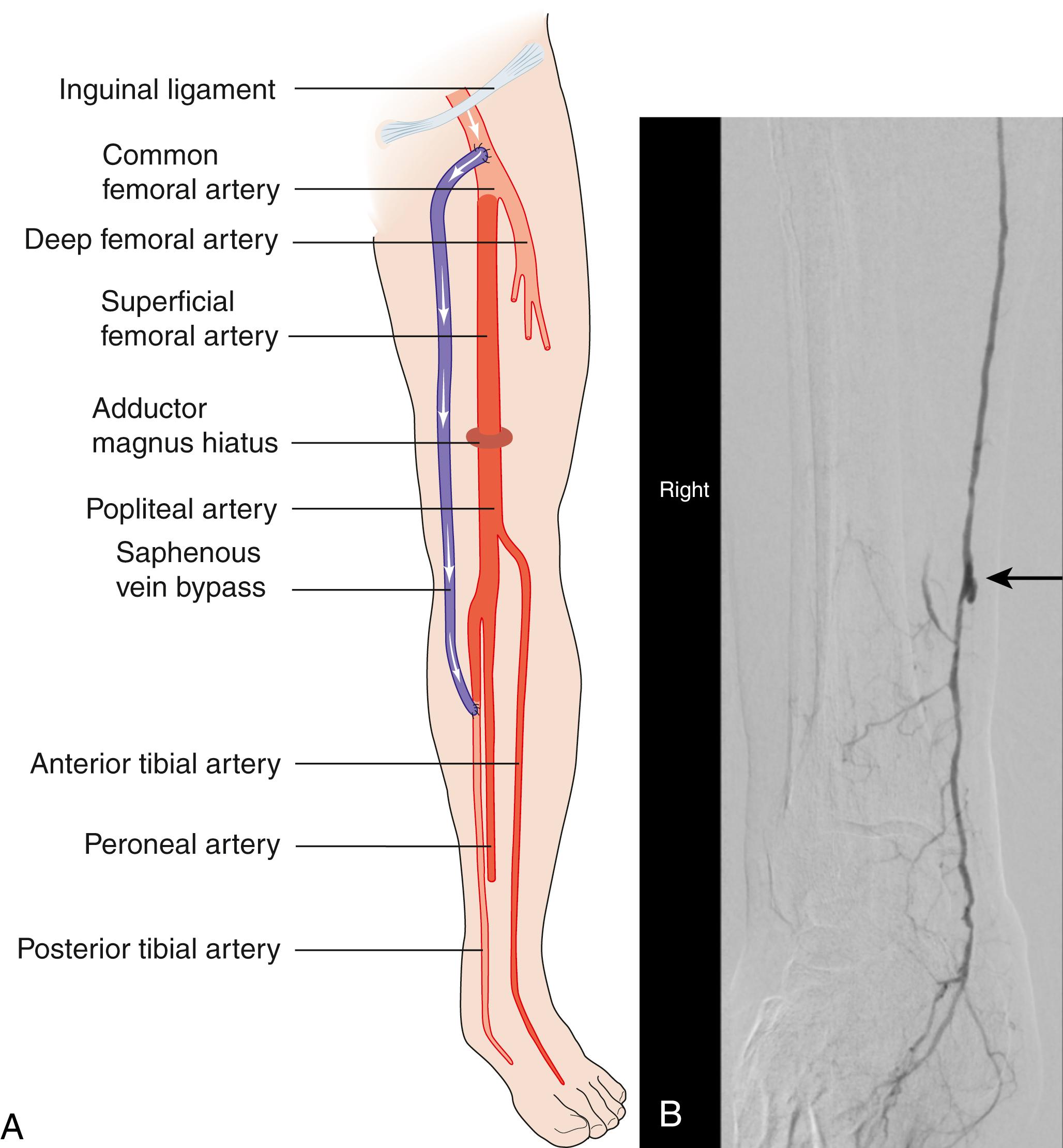 Fig. 22.10, Femorodistal bypass graft. (A) Diagram showing bypass graft from the femoral to the posterior tibial. (B) On-table angiogram showing distal end of vein graft (arrow) anastomosed to the posterior tibial artery at the ankle.