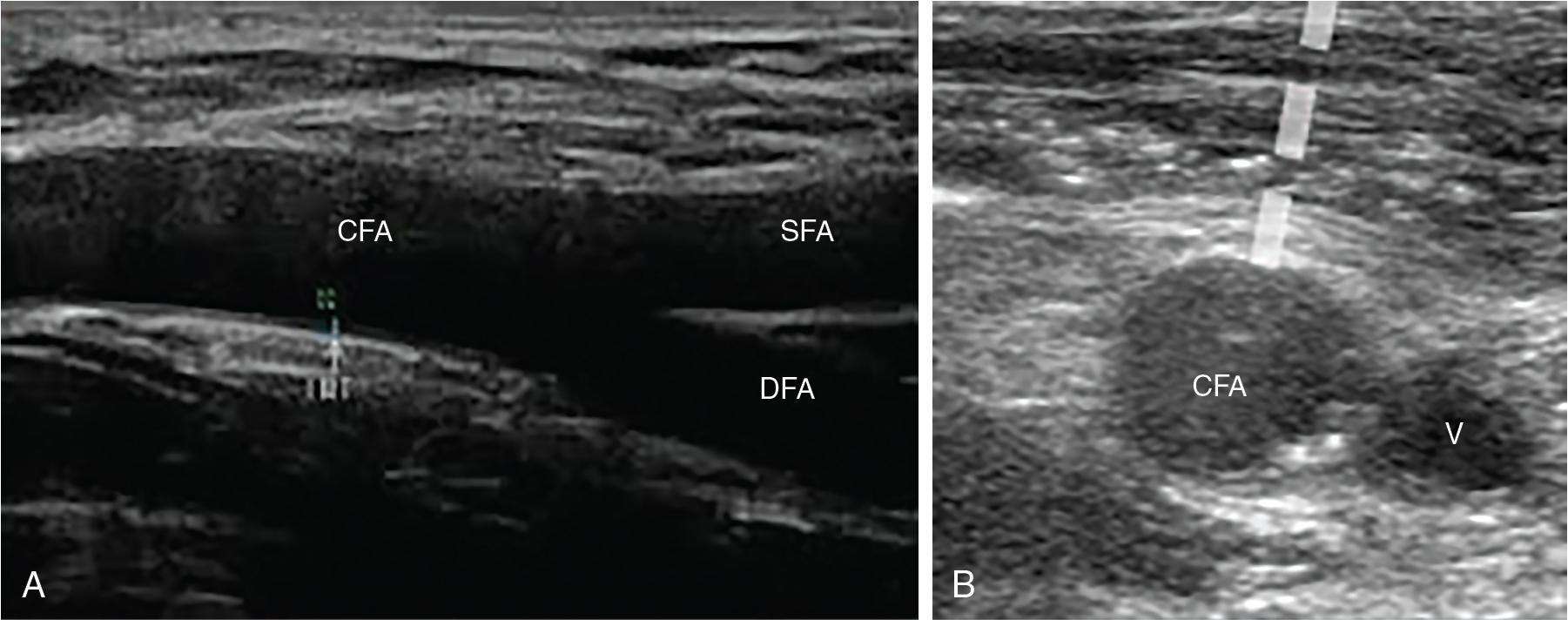 Fig. 11.1, Ultrasound-Guided Access.