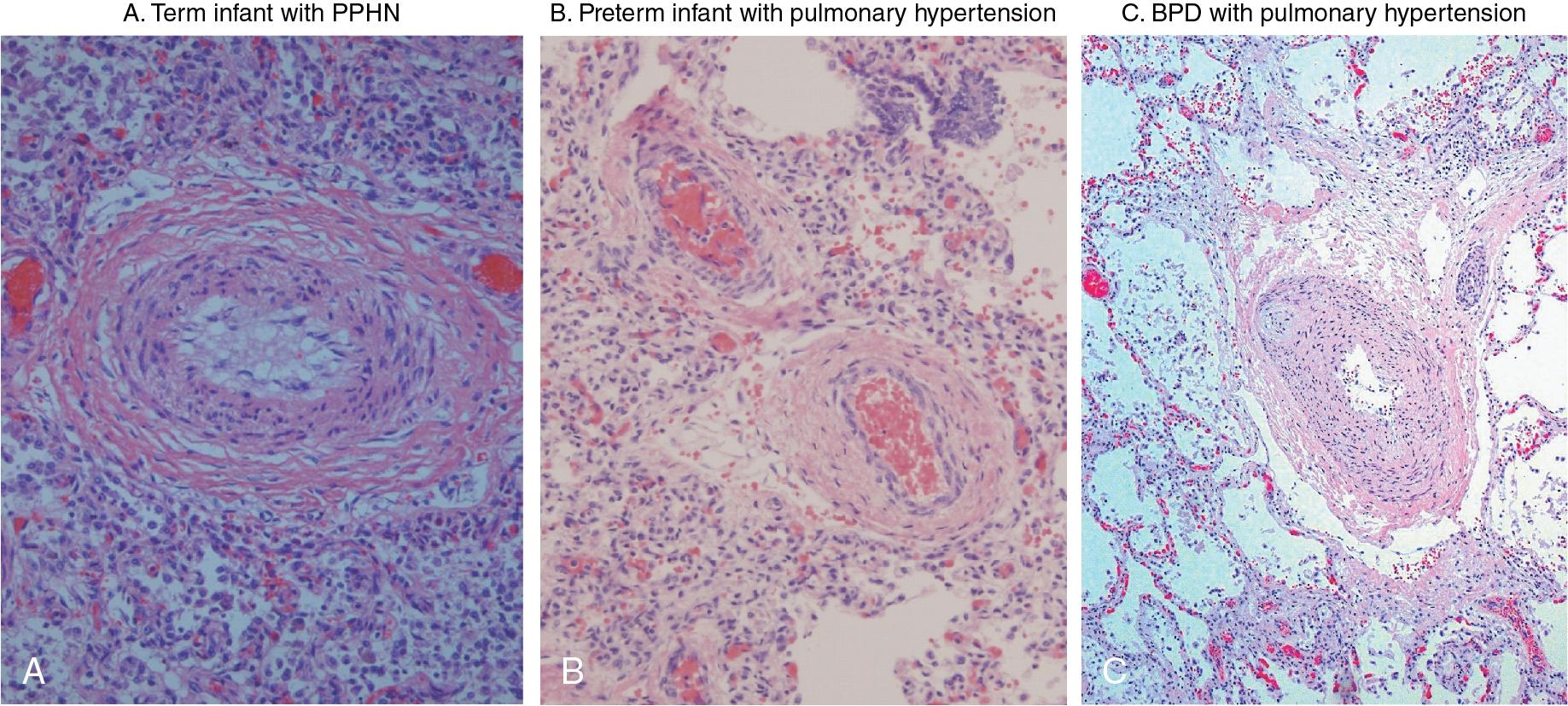 Fig. 3.5, Vascular remodeling in neonatal pulmonary hypertension.
