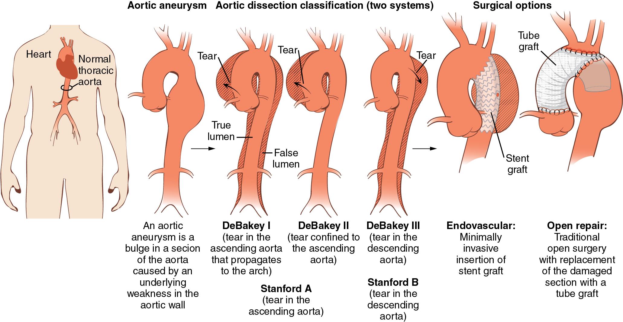 Fig. 12.1, Overview of thoracic aneurysms and dissections.