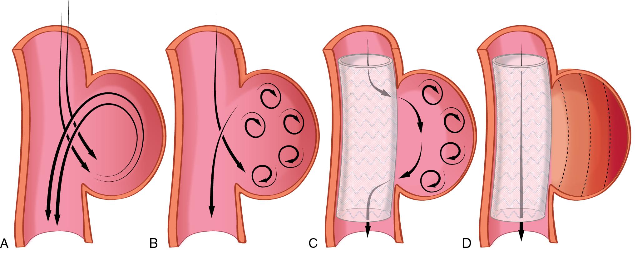 Fig. 12.2, A, Blood flow through a saccular aneurysm. B, Saccular aortic aneurysm with increased flow velocity. C, Saccular aortic aneurysm treated with a multilayer stent that decreases the flow velocity into the aneurysm. D, Saccular aneurysm that is now excluded from blood flow circulation.