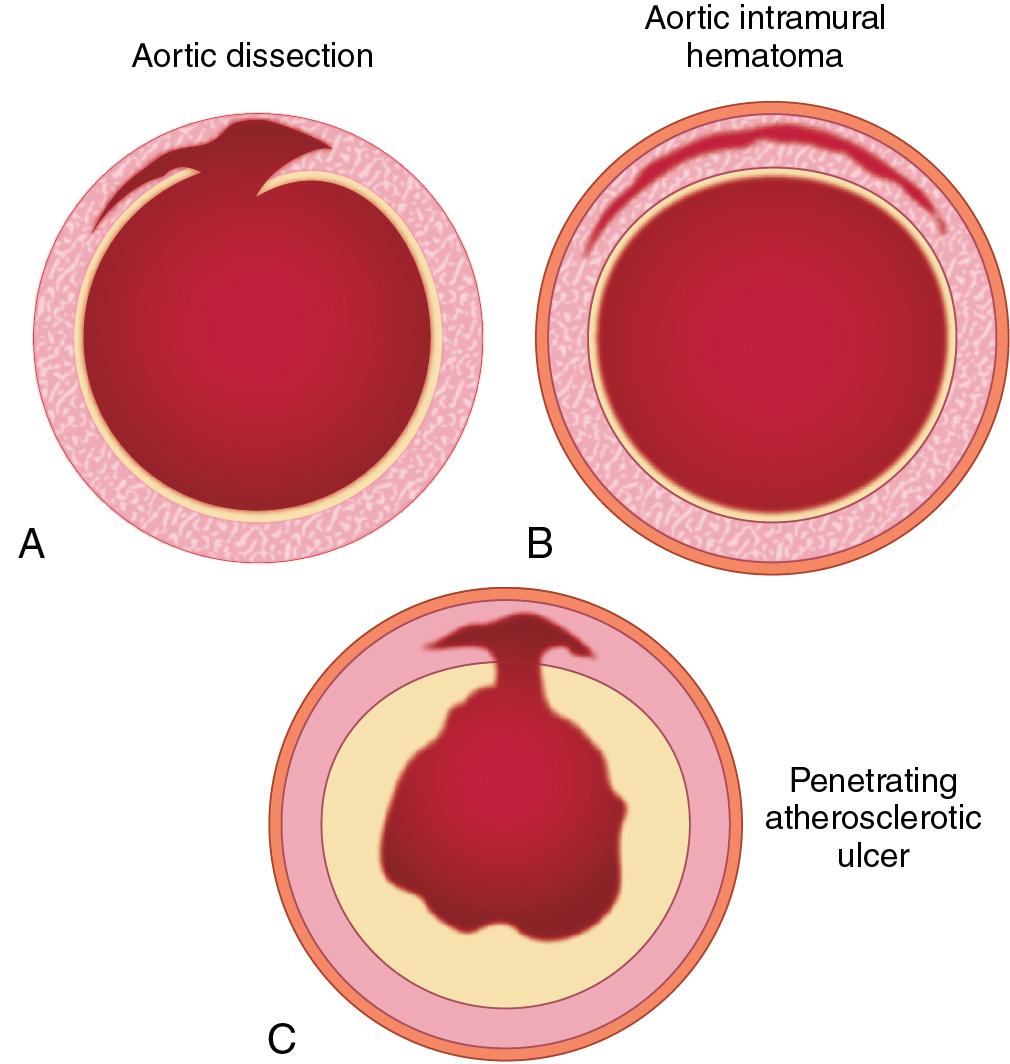 Fig. 12.3, Acute aortic syndromes. A, Classic aortic dissection. B, Aortic intramural hematoma. C, Penetrating atherosclerotic ulcer.