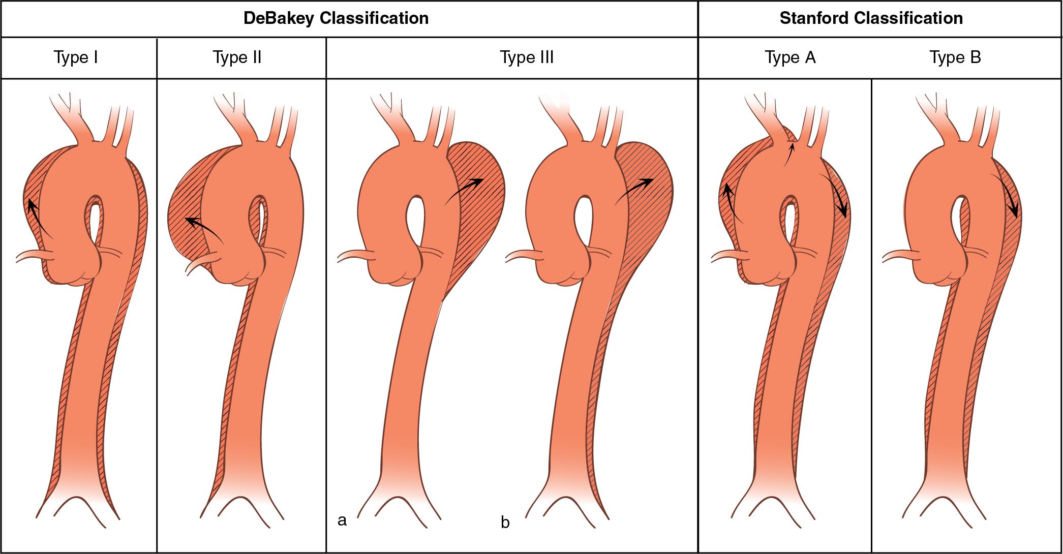 Fig. 12.4, The two most widely used classifications of aortic dissection: DeBakey and Stanford classifications. In DeBakey type I dissection the intimal tear usually originates in the proximal ascending aorta, and the dissection involves the ascending aorta and variable lengths of the aortic arch and descending thoracic and abdominal aorta. In DeBakey type II the dissection is confined to the ascending aorta. In DeBakey type III the dissection is confined to the descending thoracic aorta (type IIIa) or extends into the abdominal aorta and iliac arteries (type IIIb). Stanford type A dissection includes all cases in which the ascending aorta is involved by the dissection, with or without involvement of the arch or the descending aorta. Stanford type B includes cases in which the ascending aorta is not involved.