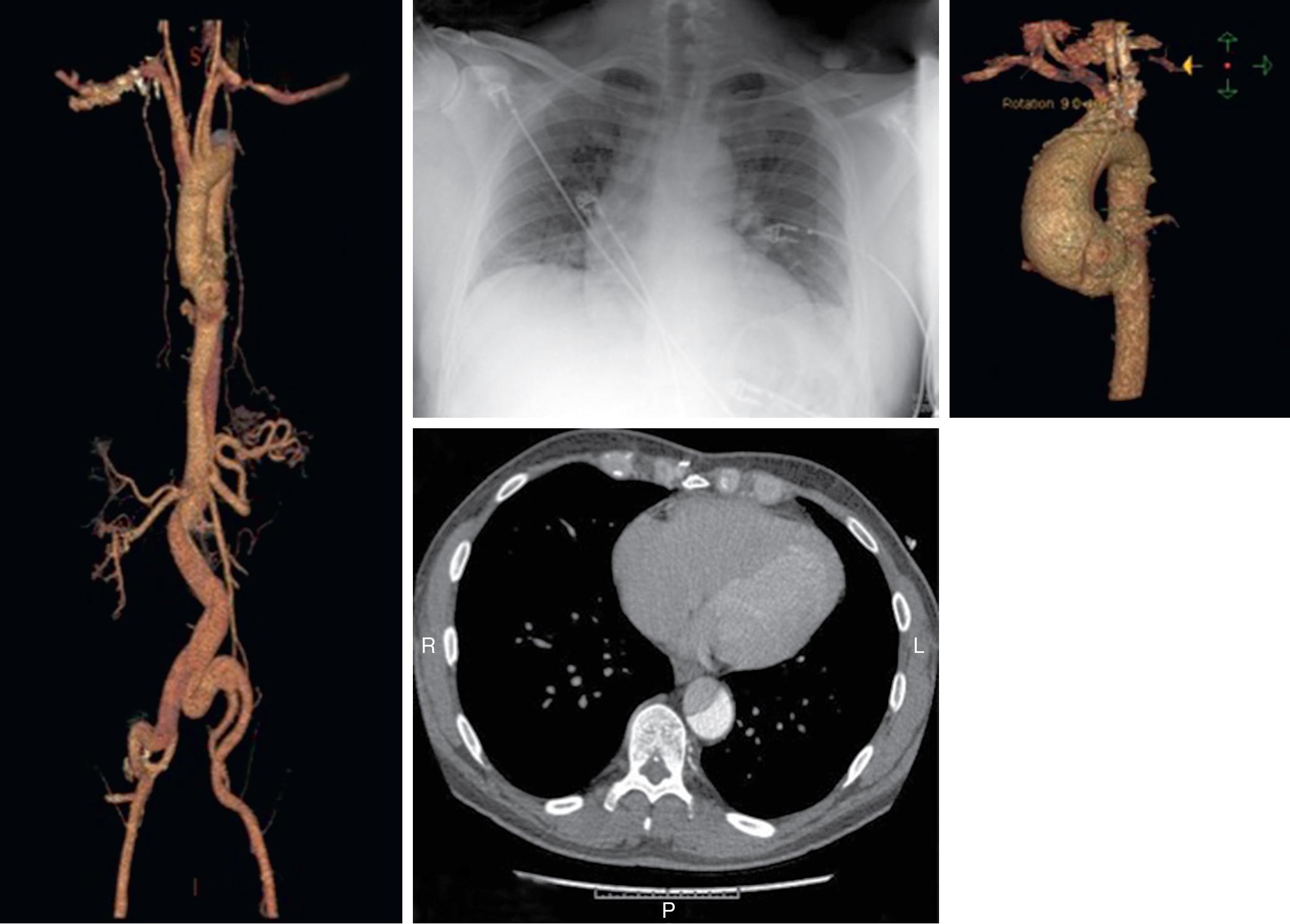 Fig. 12.5, (Clockwise from left) Tomographic reconstruction of a type B aortic dissection, chest radiography showing enlarged mediastinum, and type A aortic dissections seen on image reconstruction as well as with contrast computed tomography scanning.