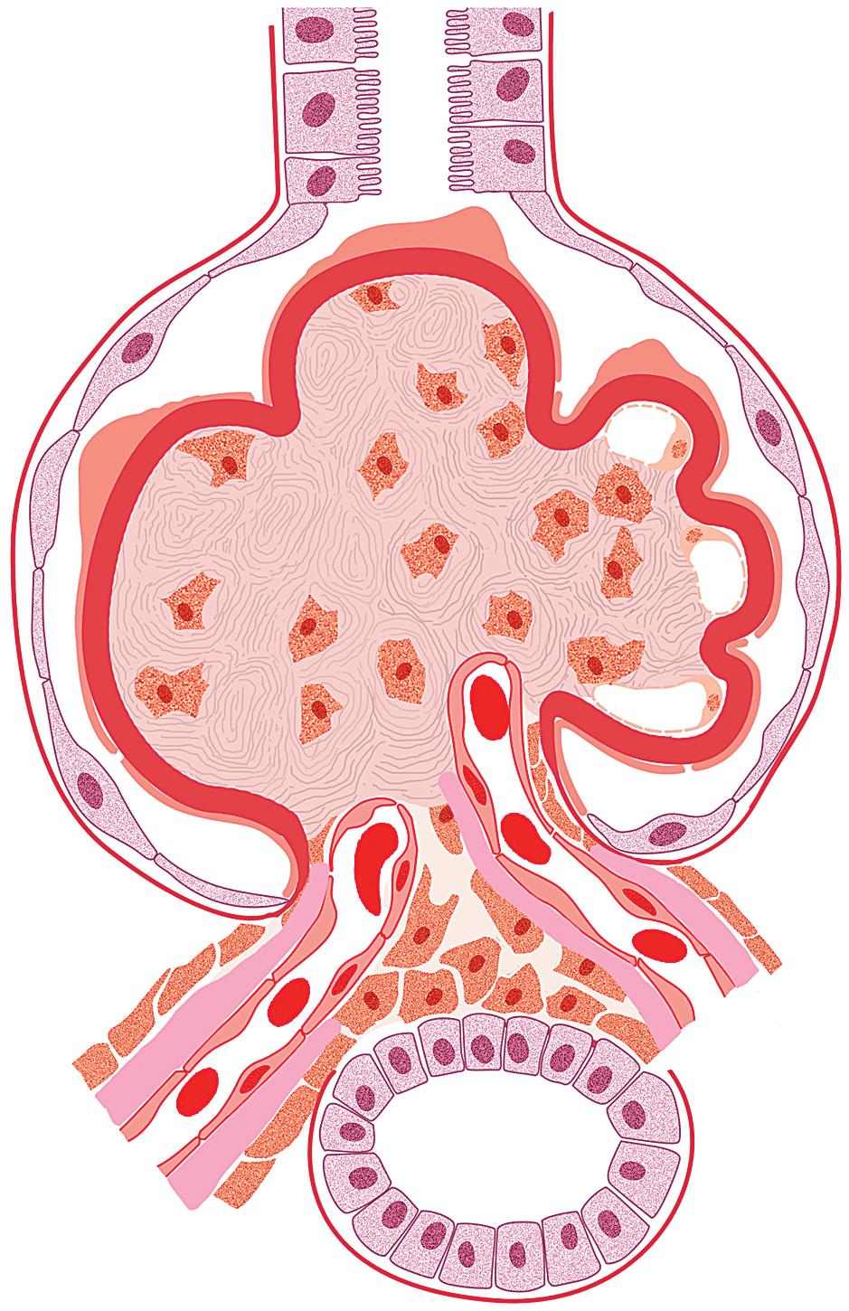 FIG. 4.1, Diabetic nephropathy.