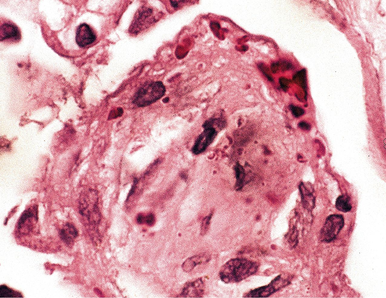 FIG. 4.11, Diabetic nephropathy.