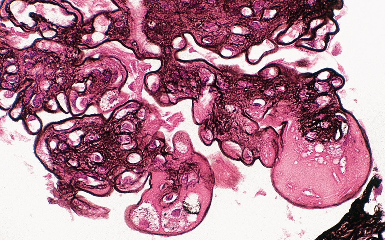 FIG. 4.12, Diabetic nephropathy.