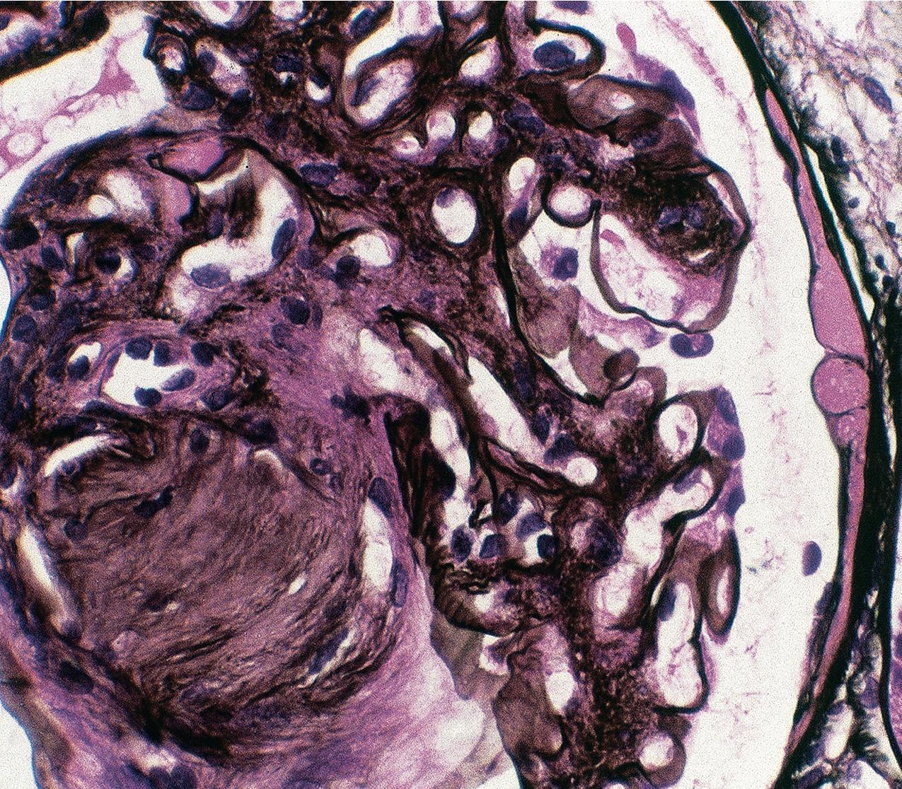 FIG. 4.13, Diabetic nephropathy.