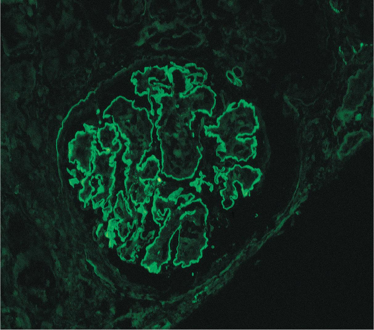 FIG. 4.14, Diabetic nephropathy.