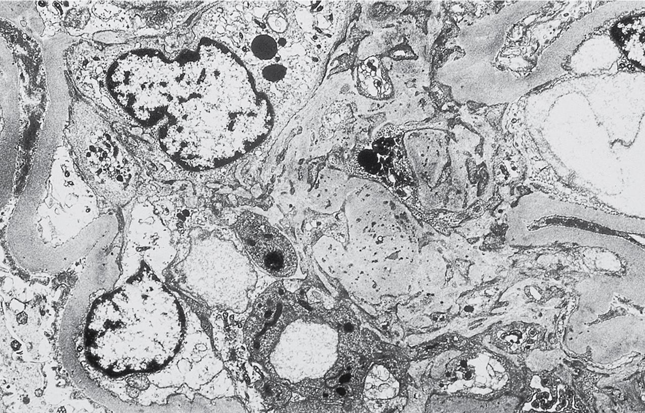 FIG. 4.15, Diabetic nephropathy.