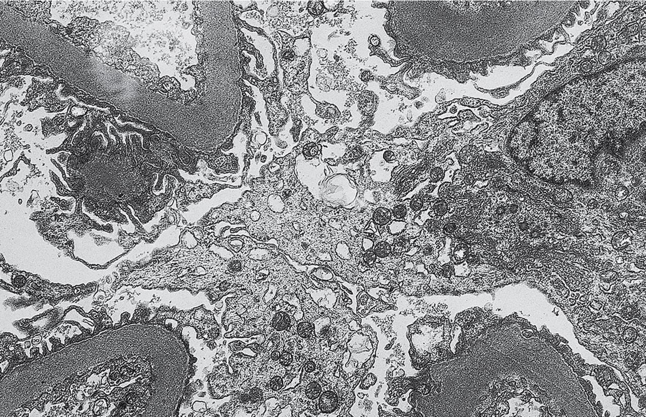 FIG. 4.16, Diabetic nephropathy.