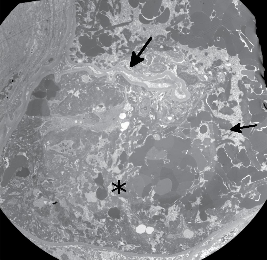 FIG. 4.17, Diabetic nephropathy.