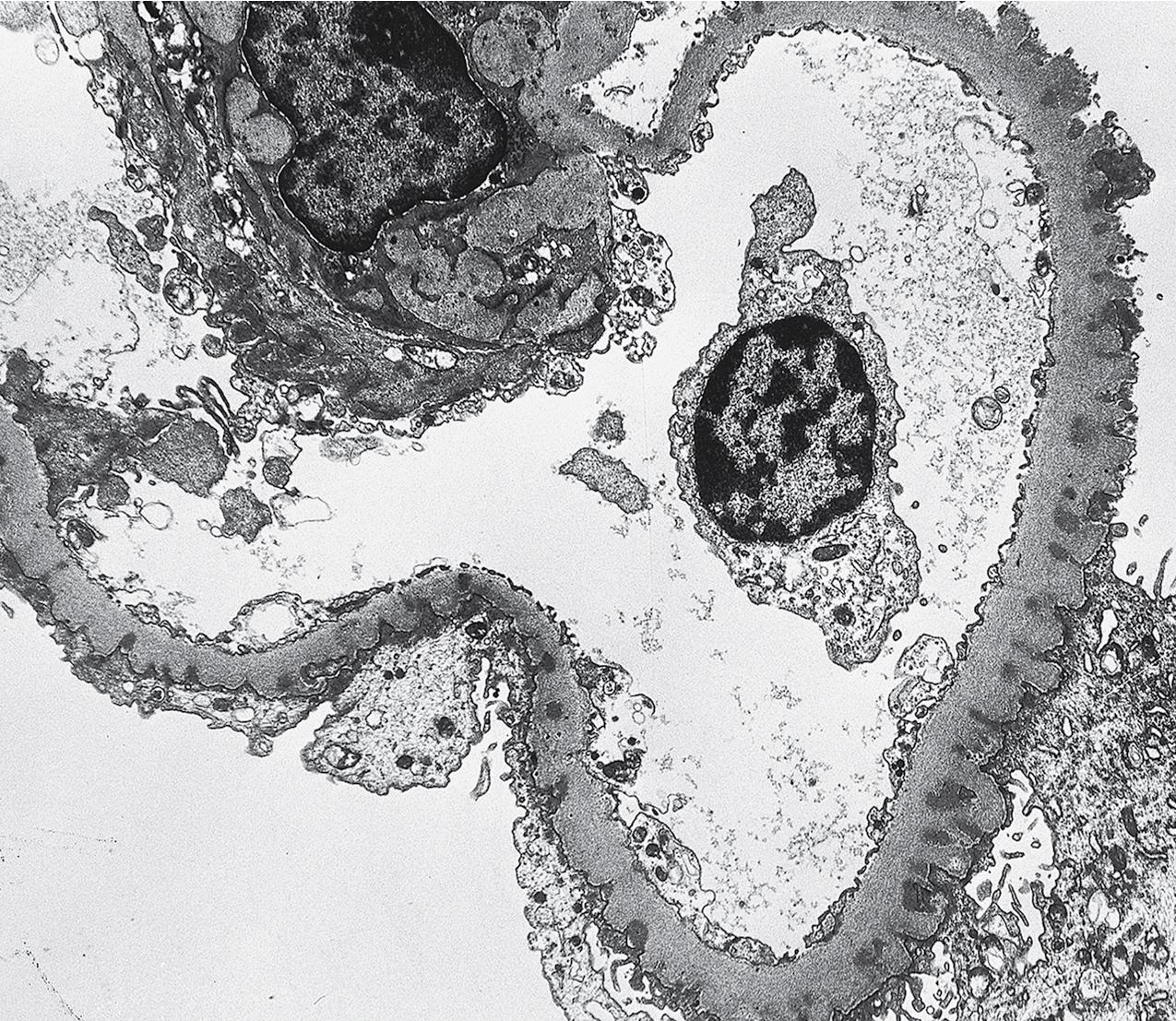 FIG. 4.18, Diabetic nephropathy.