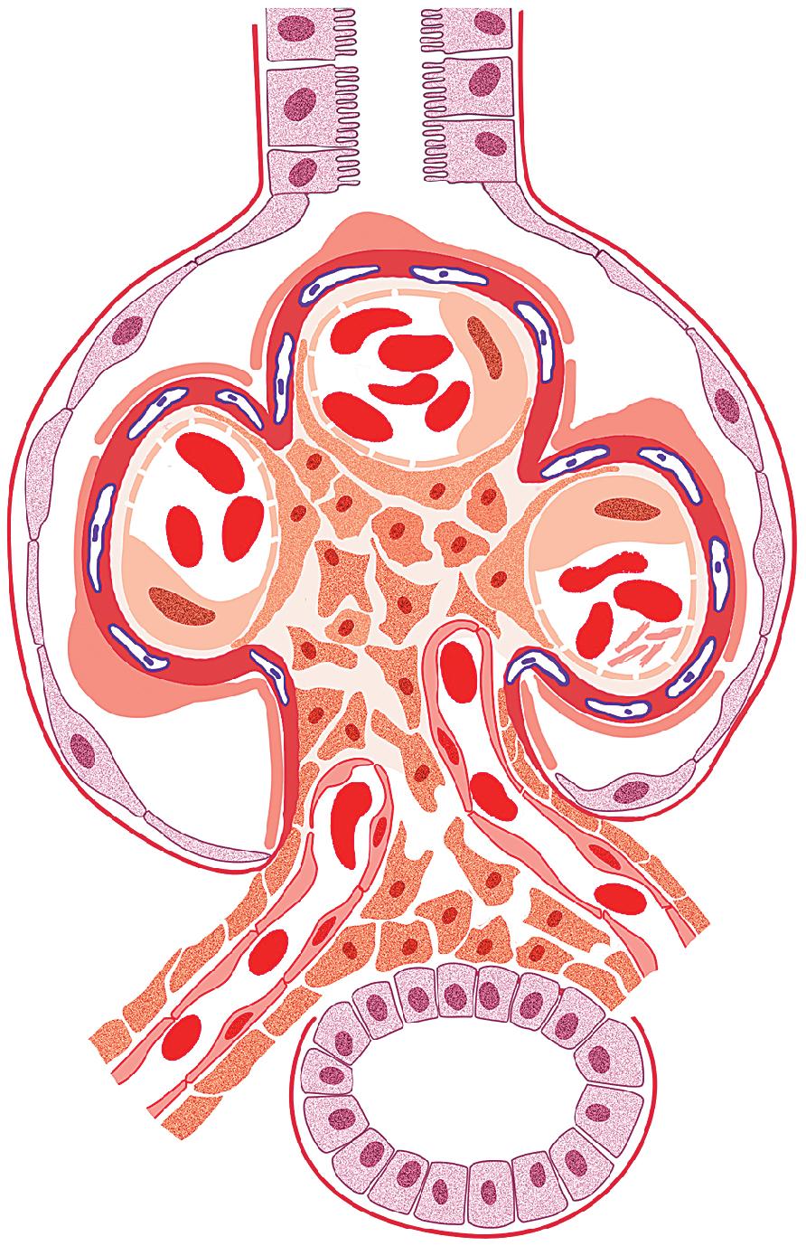 FIG. 4.19, Chronic thrombotic microangiopathy shows a double contour appearance of glomerular basement membranes by light microscopy, because of increased lamina rara interna, often with flocculent fibrin degradation products. Occasional fibrin tactoids may be seen by electron microscopy.