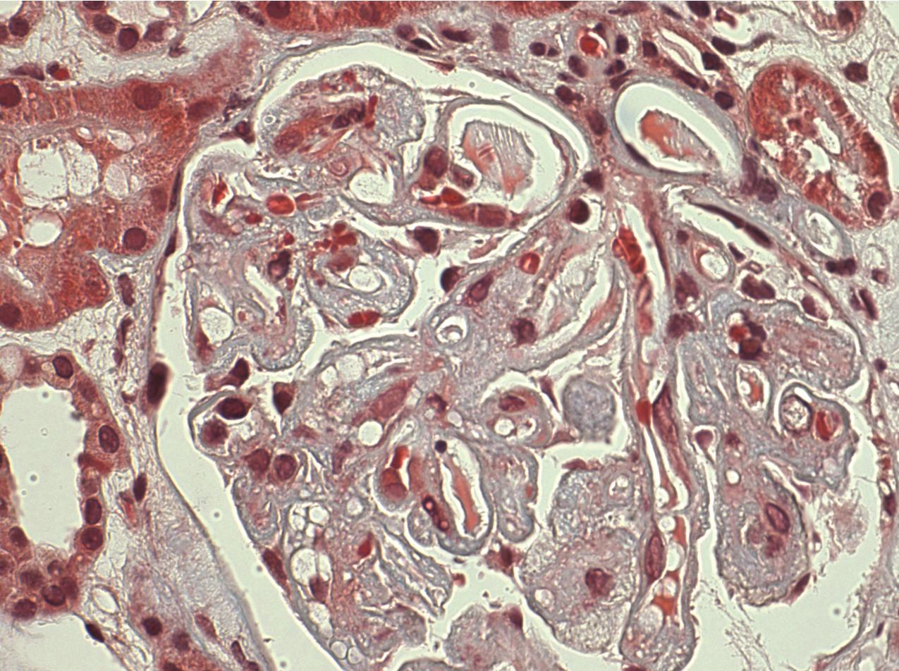 FIG. 4.22, Thrombotic microangiopathy.