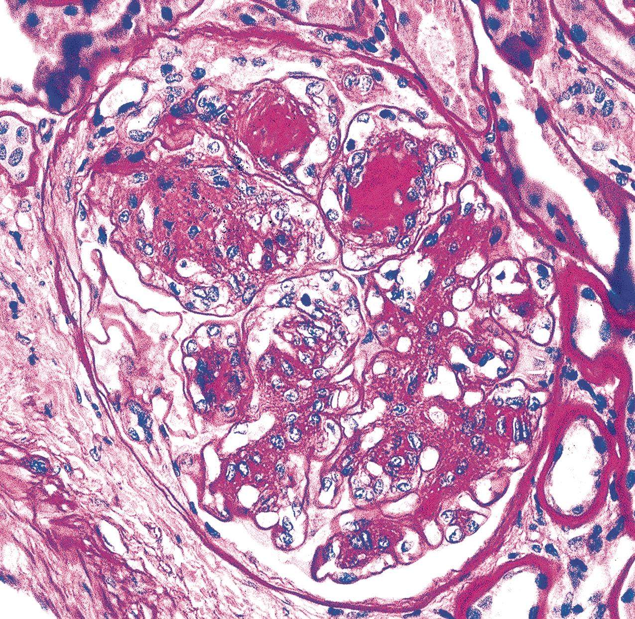 FIG. 4.5, Diabetic nephropathy.