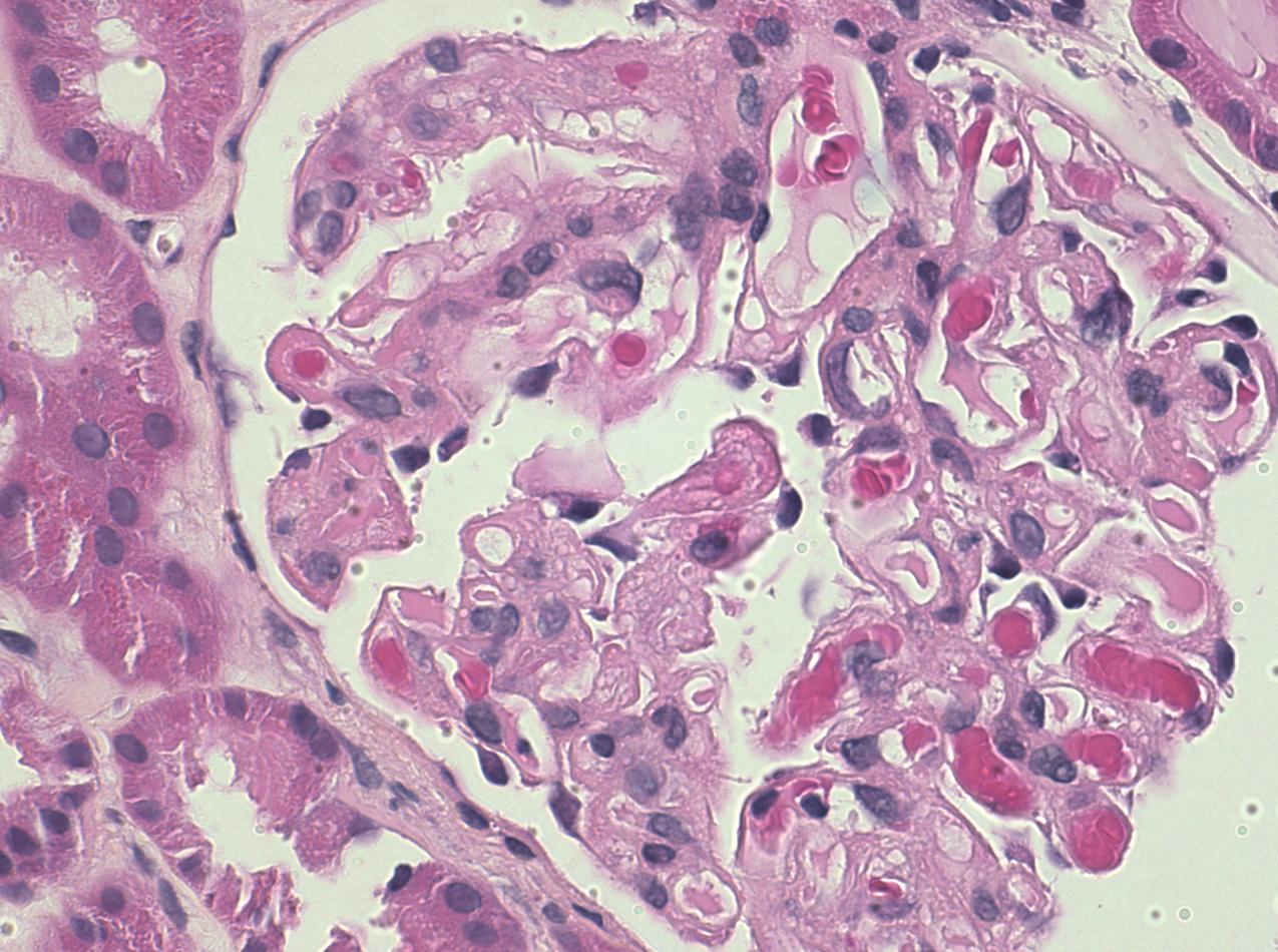 FIG. 4.21, Thrombotic microangiopathy.