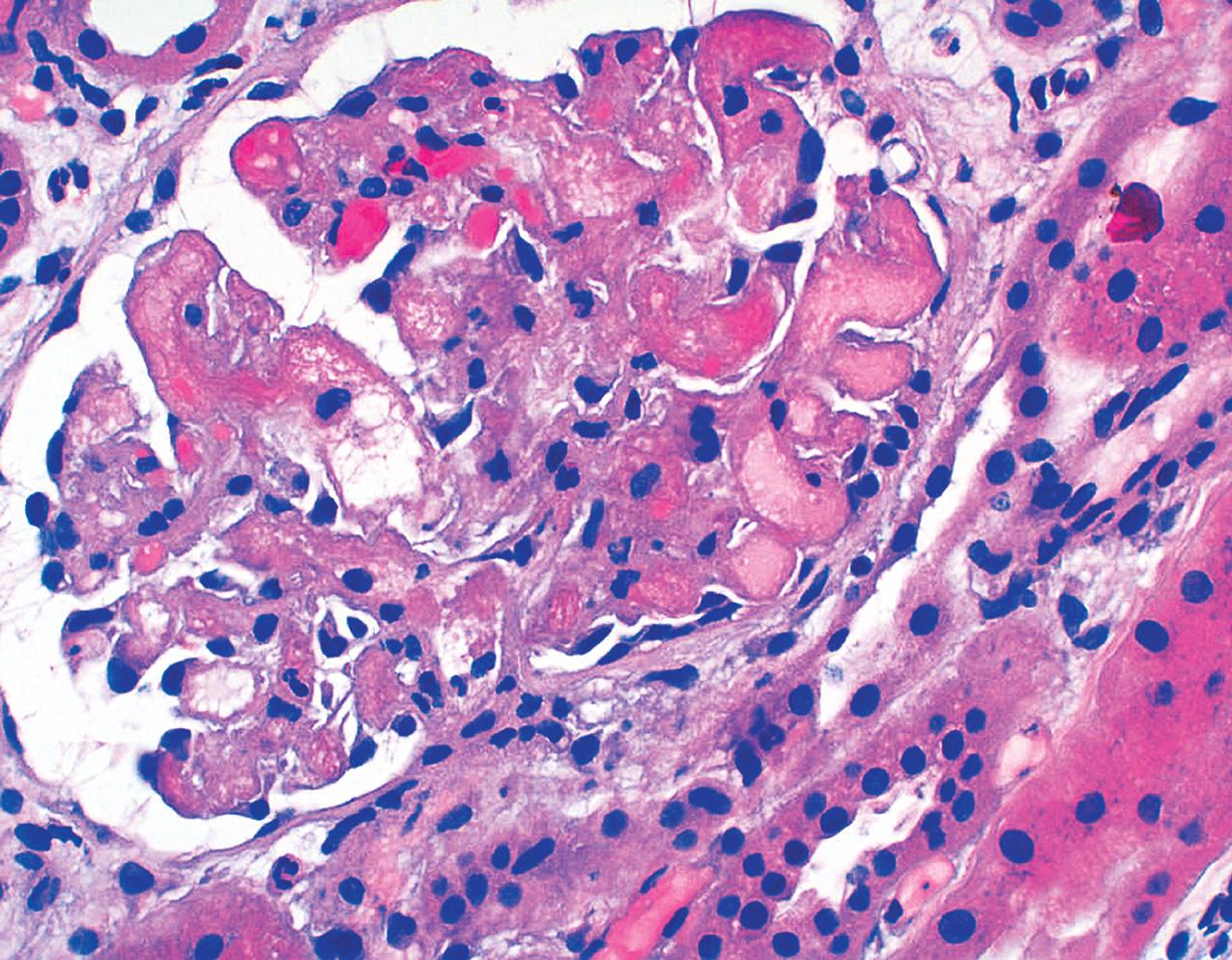 FIG. 4.20, Thrombotic microangiopathy.