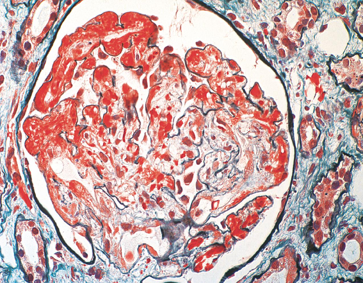 FIG. 4.23, Thrombotic microangiopathy.