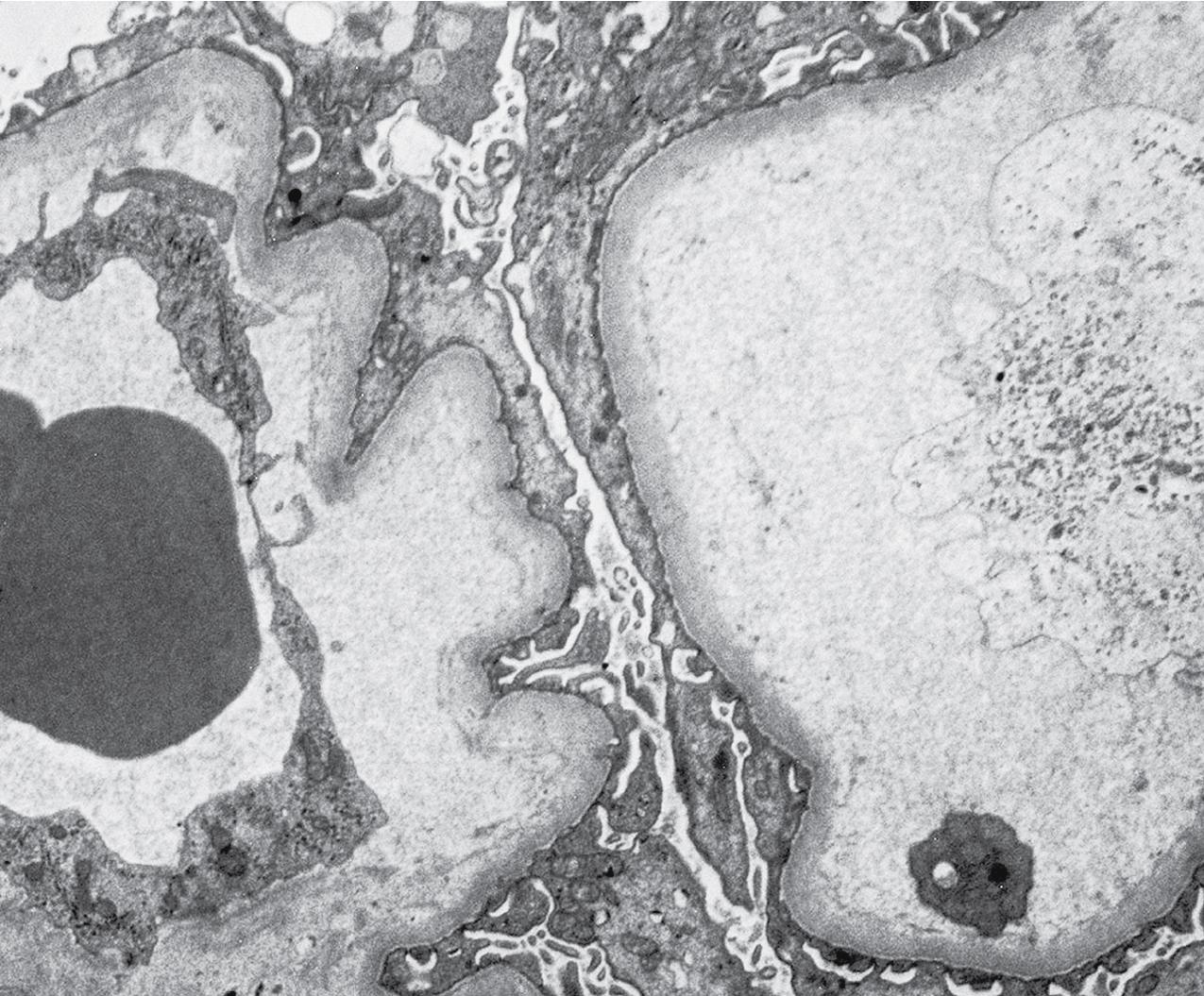 FIG. 4.24, Thrombotic microangiopathy.