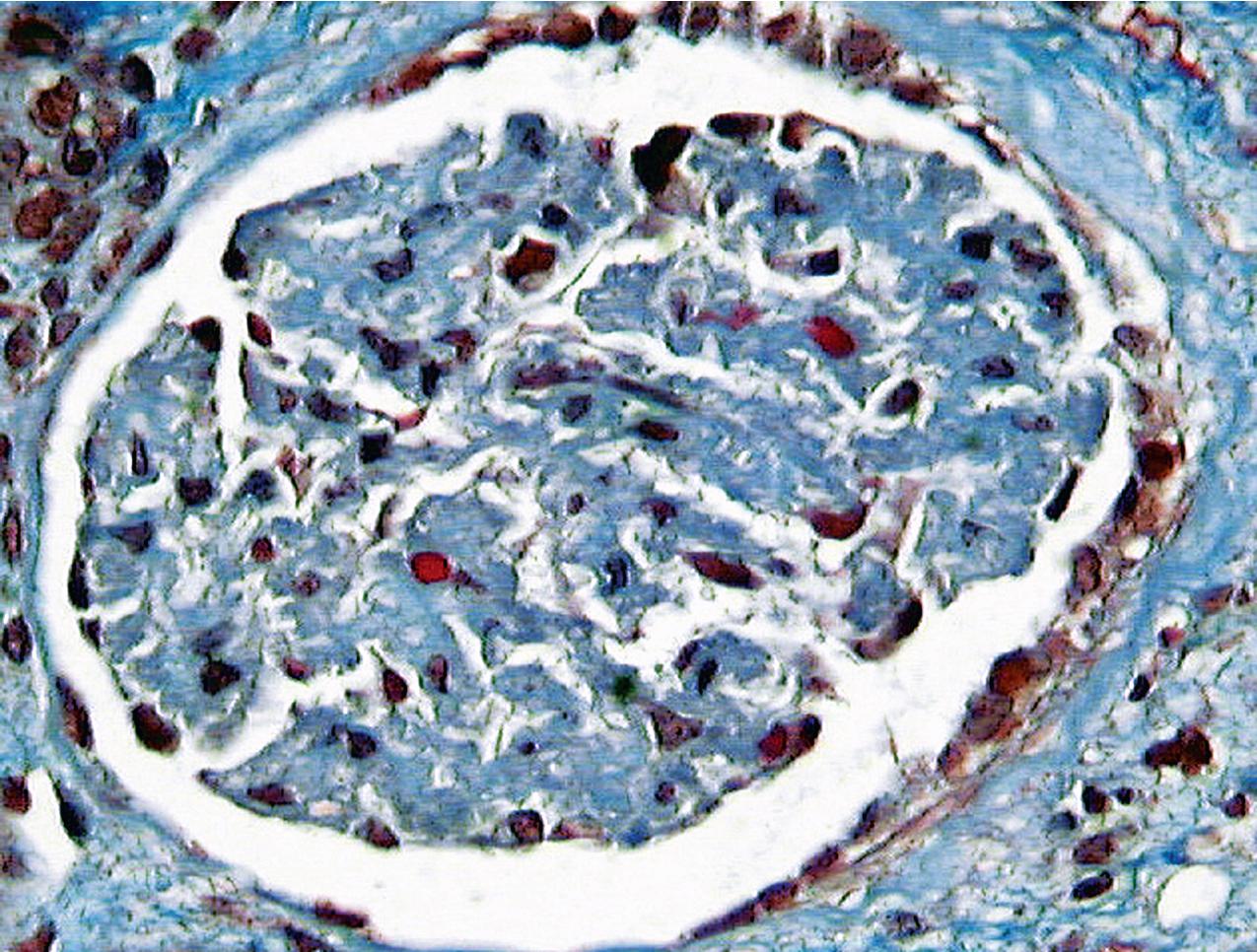 FIG. 4.25, Thrombotic microangiopathy.