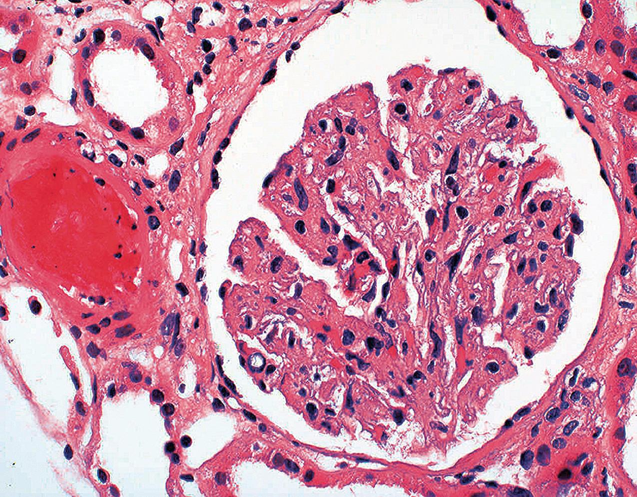 FIG. 4.26, Thrombotic microangiopathy.