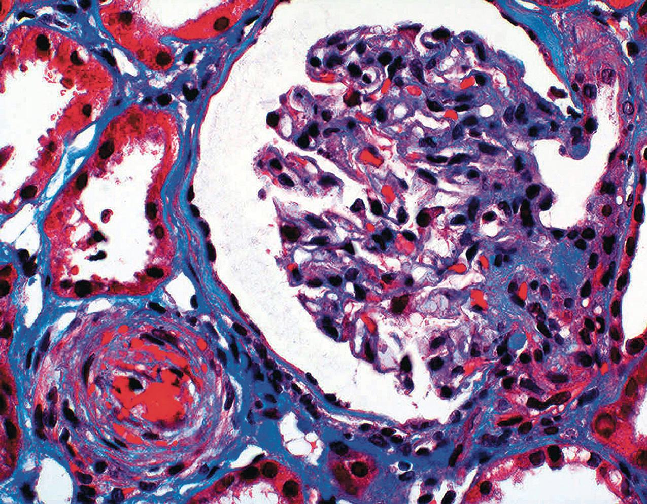 FIG. 4.30, Thrombotic microangiopathy.