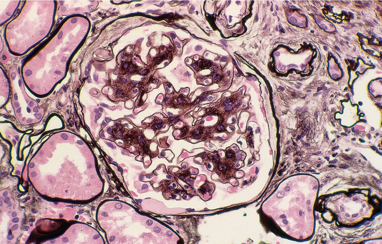 FIG. 4.4, Diabetic nephropathy.