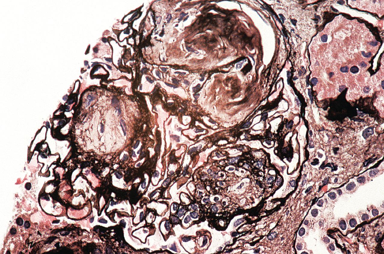 FIG. 4.33, Thrombotic microangiopathy.