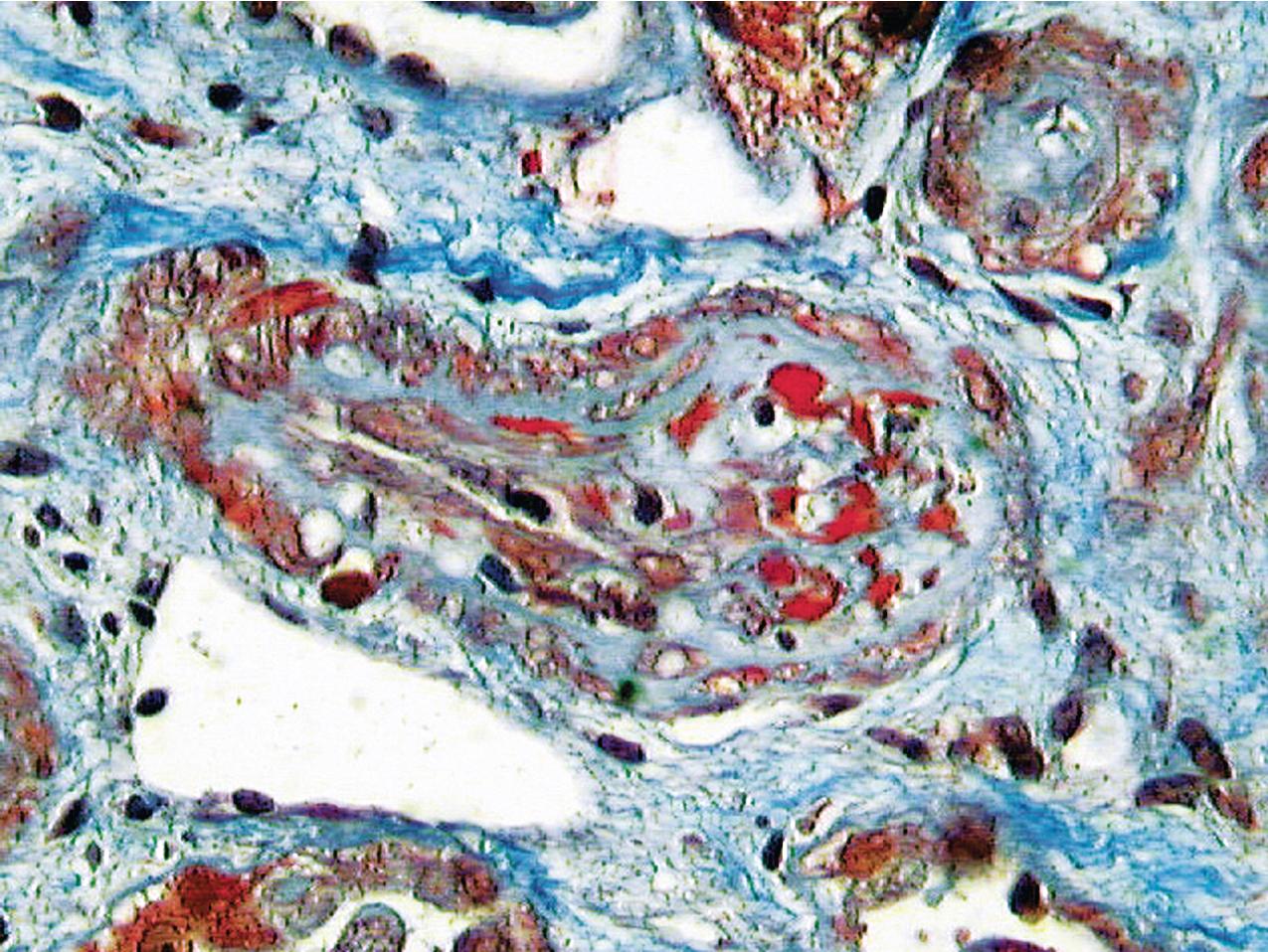 FIG. 4.34, Thrombotic microangiopathy.