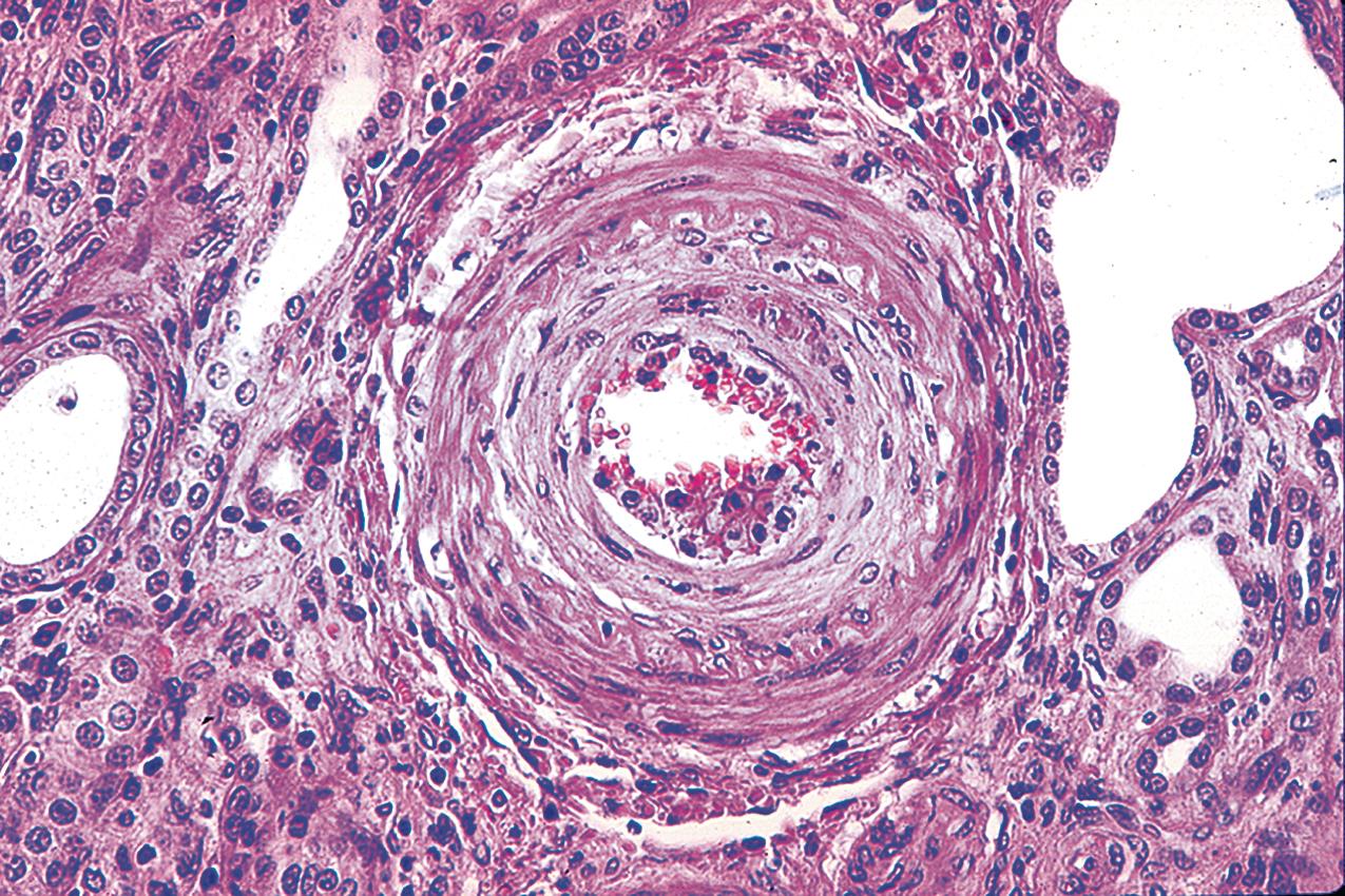 FIG. 4.35, Thrombotic microangiopathy.