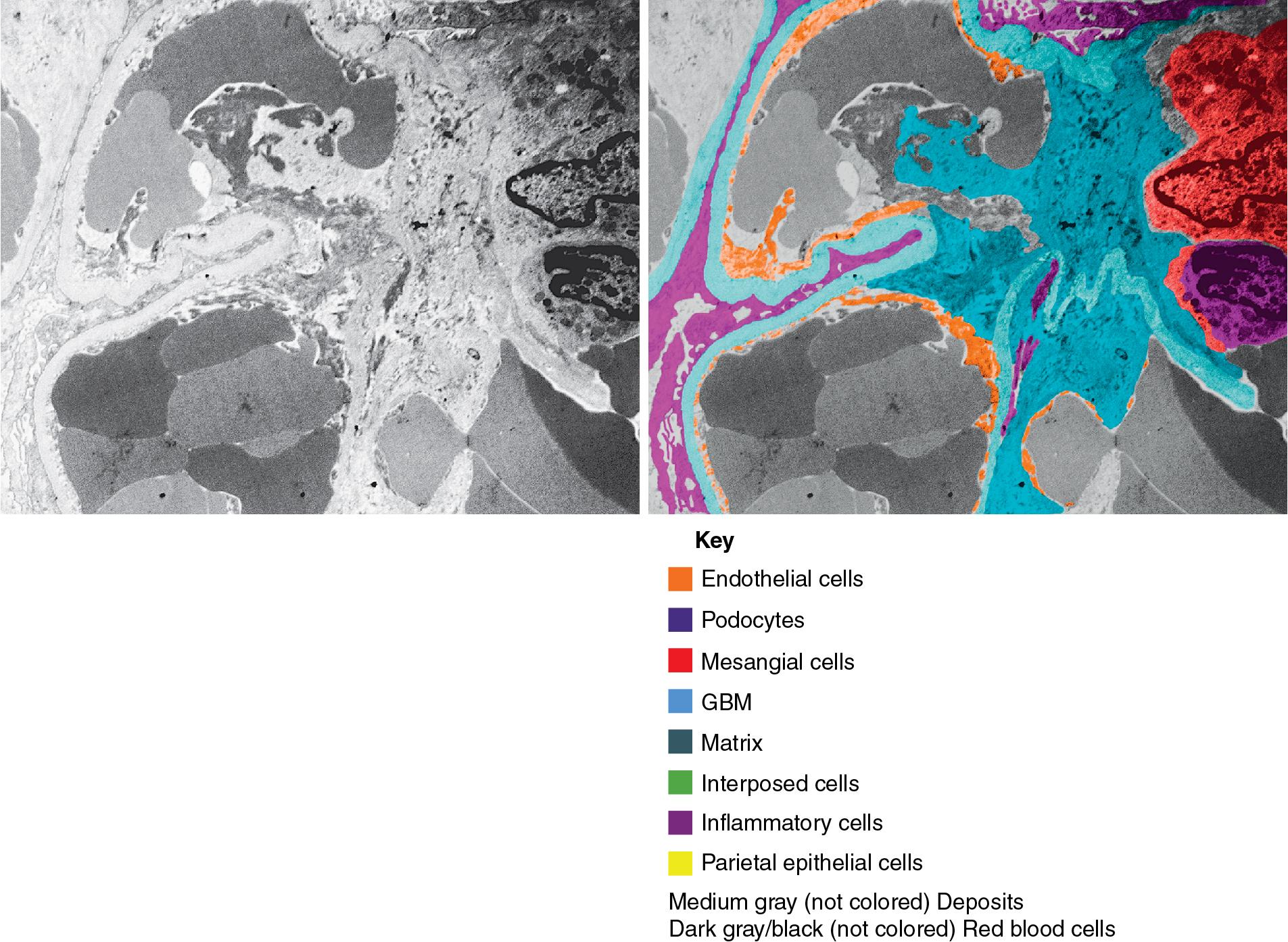 FIG. 4.40, Thrombotic microangiopathy.