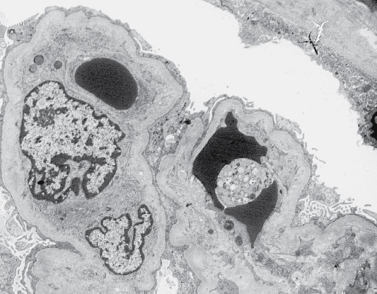 FIG. 4.39, Thrombotic microangiopathy.